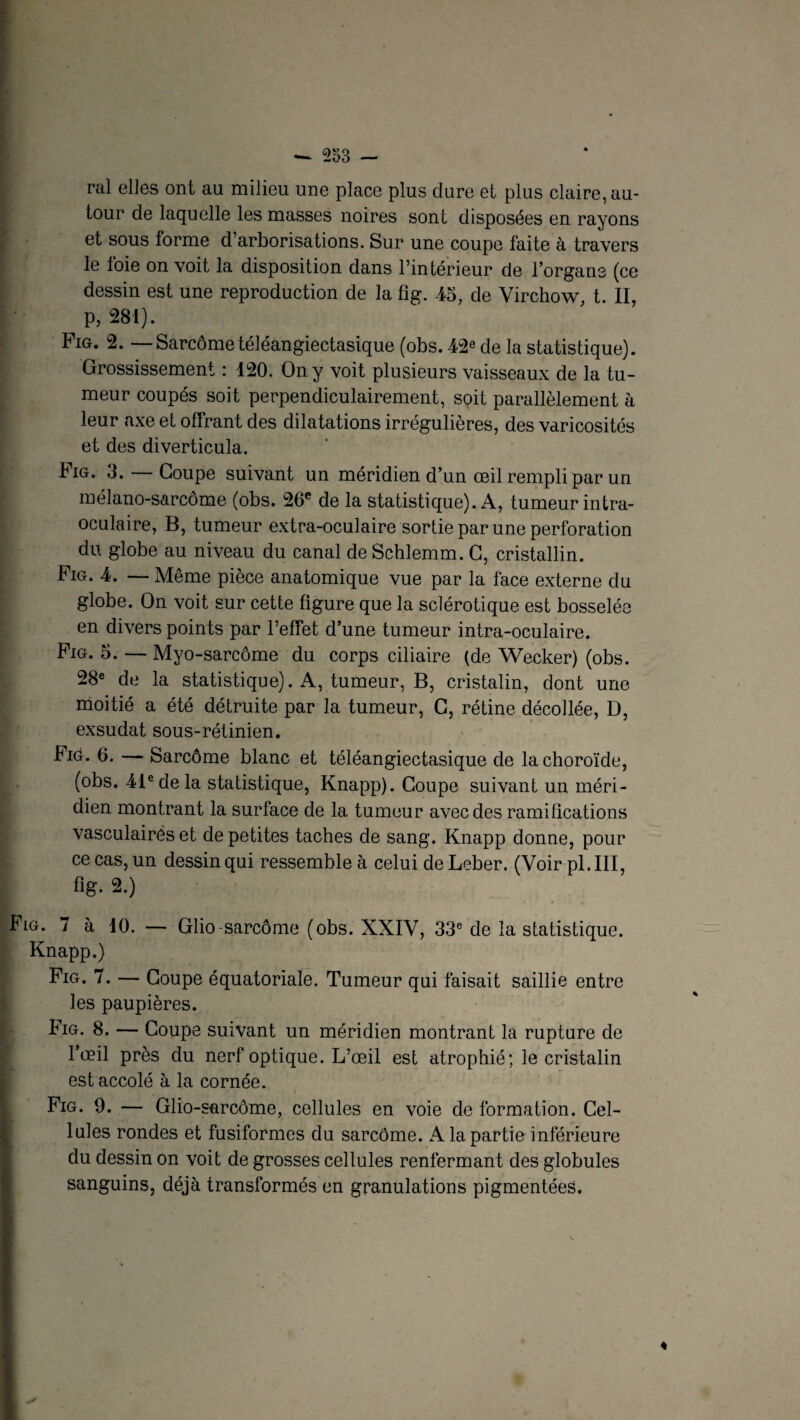 ral elles ont au milieu une place plus dure et plus claire, au¬ tour de laquelle les masses noires sont disposées en rayons et sous lorme d’arborisations. Sur une coupe faite à travers le loie on voit la disposition dans l’intérieur de l’organe (ce dessin est une reproduction de la fig. 45, de Virchow t. II, ^ P? 281). Fig. 2. — Sarcometéléangiectasique (obs. 42e de la statistique). Grossissement : 120. On y voit plusieurs vaisseaux de la tu¬ meur coupés soit perpendiculairement, soit parallèlement à leur axe et offrant des dilatations irrégulières, des varicosités et des diverticula. Fig. 3. — Coupe suivant un méridien d’un œil rempli par un mélano-sarcôme (obs. 26e de la statistique). A, tumeur intra- oculaire, B, tumeur extra-oculaire sortie par une perforation du globe au niveau du canal de Schlemm. G, cristallin. Fig. 4. — Même pièce anatomique vue par la face externe du globe. On voit sur cette ligure que la sclérotique est bosselée en divers points par l’effet d’une tumeur intra-oculaire. Fig. 5. — Myo-sarcôme du corps ciliaire (de Wecker) (obs. 28e de la statistique). A, tumeur, B, cristalin, dont une moitié a été détruite par la tumeur, G, rétine décollée, D, exsudât sous-rétinien. Fig. 6. — Sarcôme blanc et téléangiectasique de la choroïde, (obs. 41e de la statistique, Knapp). Coupe suivant un méri¬ dien montrant la surface de la tumeur avec des ramifications vasculaires et de petites taches de sang. Knapp donne, pour ce cas, un dessin qui ressemble à celui de Leber. (Voir pi. III, fig. 2.) Fig. 7 à 10. — Glio-sarcôme (obs. XXIV, 33e de la statistique. Knapp.) Fig. 7. — Coupe équatoriale. Tumeur qui faisait saillie entre les paupières. Fig. 8. — Coupe suivant un méridien montrant la rupture de l’œil près du nerf optique. L’œil est atrophié; le cristalin est accolé à la cornée. Fig. 9. — Glio-s-arcôme, cellules en voie de formation. Cel¬ lules rondes et fusiformes du sarcôme. A la partie inférieure du dessin on voit de grosses cellules renfermant des globules sanguins, déjà transformés en granulations pigmentées.