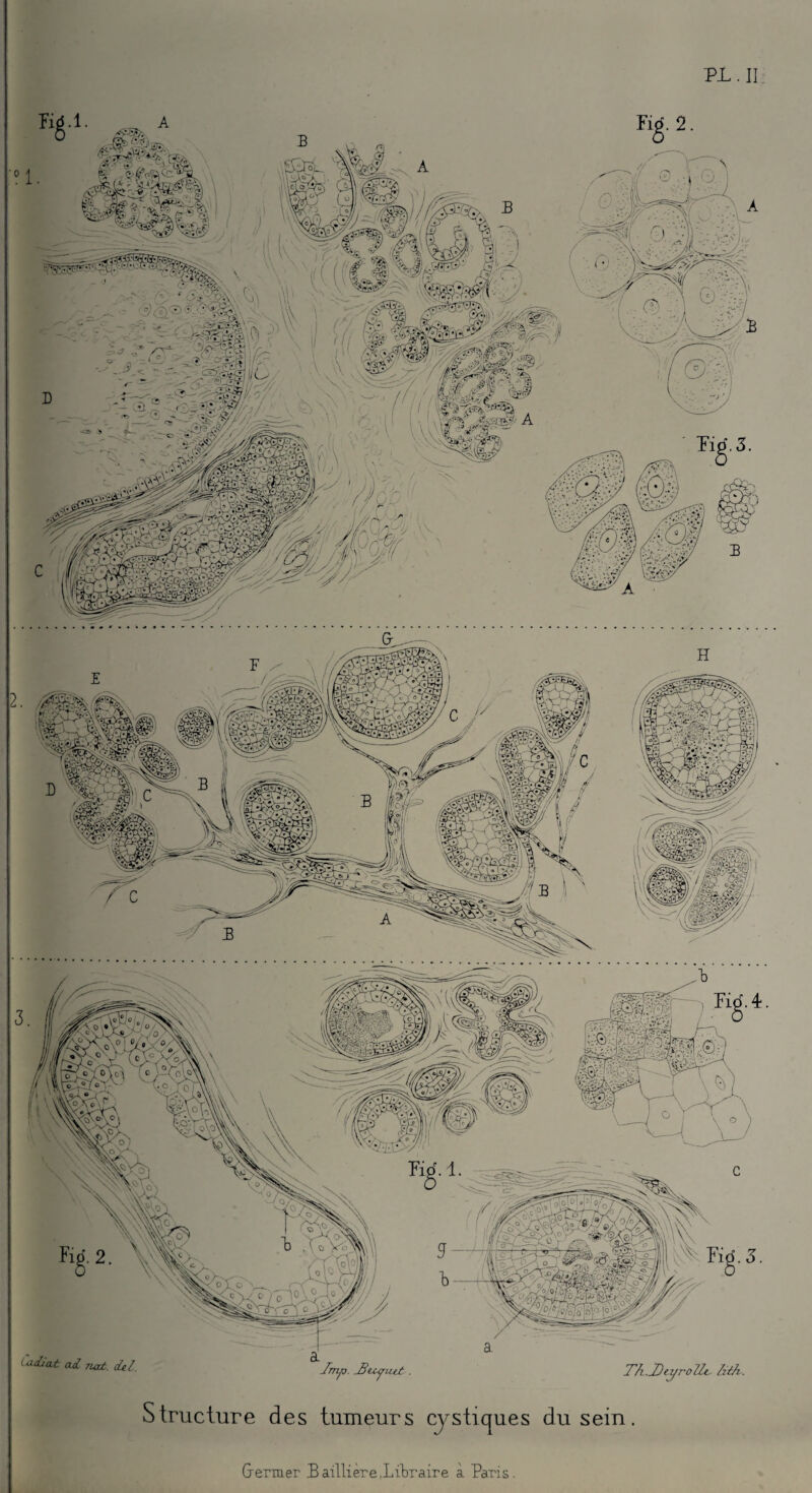 1. °i. ,*■ •• «y . • » P- GP'LP^ ~s\ r»S0w \\r S.J'ï D ■ • • .. • • - V', ■ - ■ mm o. îmà - - . « . % : ■ îi ? > ; mi, <vV: . | ' , i,;Sfe-' ÿ: - WMf ' o-%) ‘îT' ;G • || ■ ® Étl^llgS5 WïJ&g ( adiat ad TLat. del. lmp. jStcyiut . Th..Dtyro7lc hih. Structure des tumeurs cystiques du sein Germer 3 aillière,Libraire à Paris