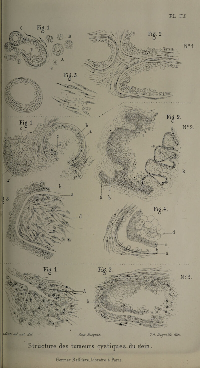 PL US xiiat cuinat dti. _Tny3._Bicyiizt. T'ii iDez/roUt- lith. Structure des tumeurs cy s tique s du s'em. Germer Bailli ere, Lit r aire à Pans.