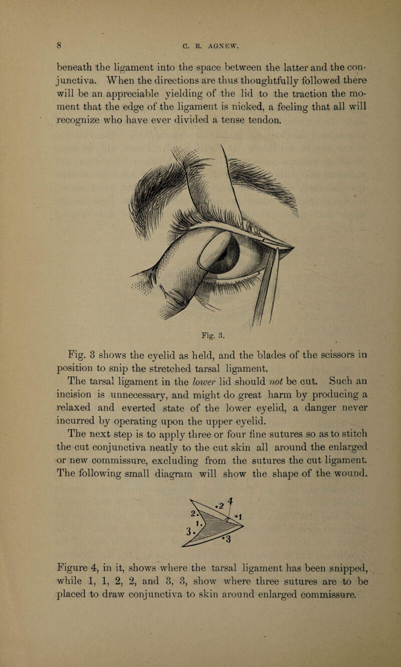 beneath the ligament into the space between the latter and the con¬ junctiva. When the directions are thus thoughtfully followed there will be an appreciable yielding of the lid to the traction the mo¬ ment that the edge of the ligament is nicked, a feeling that all will recognize who have ever divided a tense tendon. Fig. 3. Fig. 3 shows the eyelid as held, and the blades of the scissors in position to snip the stretched tarsal ligament. The tarsal ligament in the lower lid should not be cut. Such an incision is unnecessary, and might do great harm by producing a relaxed and everted state of the lower eyelid, a danger never incurred by operating upon the upper eyelid. The next step is to apply three or four fine sutures so as to stitch the cut conjunctiva neatly to the cut skin all around the enlarged or new commissure, excluding from the sutures the cut ligament. The following small diagram will show the shape of the wound. Figure 4, in it, shows where the tarsal ligament has been snipped, while 1, 1, 2, 2, and 3, 3, show where three sutures are to be placed to draw conjunctiva to skin around enlarged commissure.