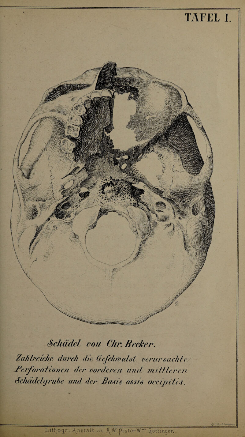 TAFEL I Schädel von Chr. Hecker. Zahlreiche diurh die Gcfchwnlsi verursachte Bcrforat'tonen der vo?‘dcren vnd jnittlerc/t Schädelgrube and der Basis ossts oecijjifis. Lüh(_ogr. Ajistält >-on. /y.W. pistorW Qöttincjea.