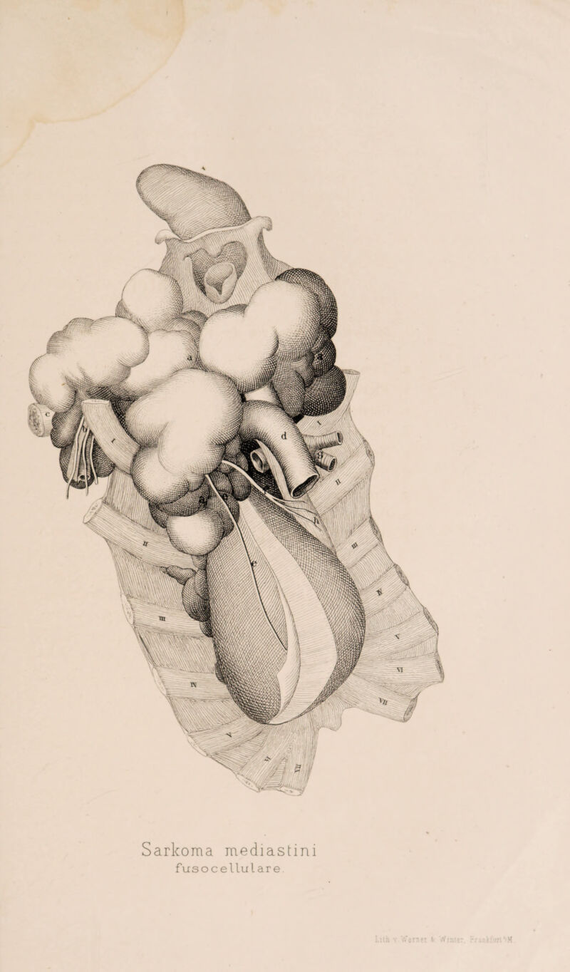 Sarlcoma mediastim fusocellulare