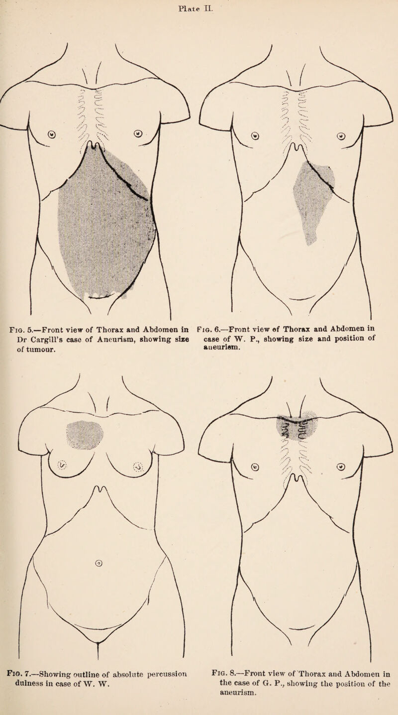 Fig. 5.—Front view of Thorax and Abdomen in Dr Cargill’s case of Aneurism, showing size of tumour. Fig. 6.—Front view of Thorax and Abdomen in case of W. P., showing size and position of aneurism. Fig. 7.—Showing outline of absolute percussion dulness in case of W. W. Fig. 8.—Front view of Thorax and Abdomen in the case of G. P.; showing the position of the aneurism.