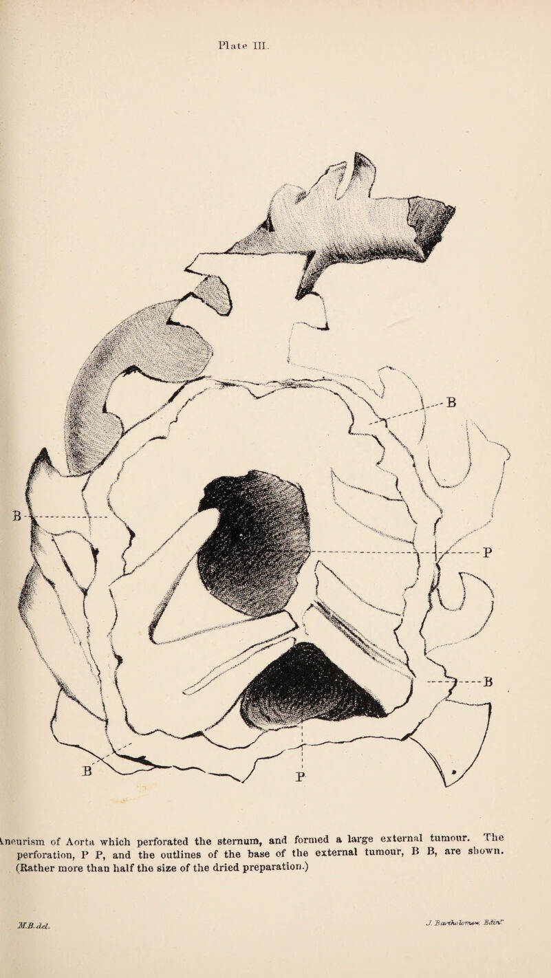 PI£ite III. Aneurism of Aorta which perforated the sternum, and formed a large external tumour. The perforation, P P, and the outlines of the base of the external tumour, B B, are shown. (Rather more than half the size of the dried prepai'ation.) MB. del. J. B ortho Icrm&w, EdinF