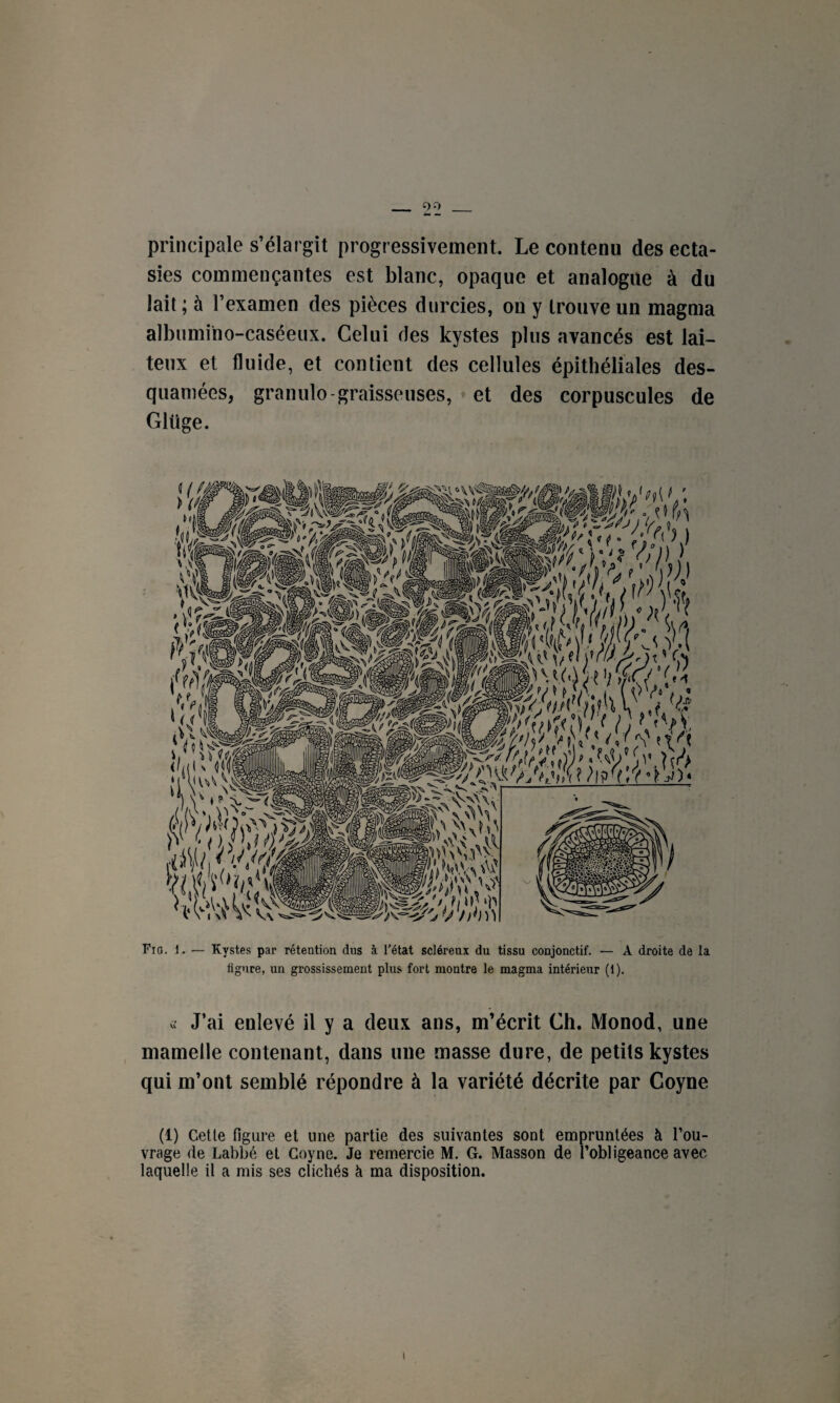 principale s’élargit progressivement. Le contenu des ecta¬ sies commençantes est blanc, opaque et analogue à du lait ; à l’examen des pièces durcies, on y trouve un magma albumino-caséeux. Celui des kystes plus avancés est lai¬ teux et fluide, et contient des cellules épithéliales des- quamées, granulo-graisseuses, et des corpuscules de Glüge. Fia. 1. — Kystes par rétention dus à l'état scléreux du tissu conjonctif. — A droite de la figure, un grossissement plus fort montre le magma intérieur (1). c, J’ai enlevé il y a deux ans, m’écrit Ch. Monod, une mamelle contenant, dans une masse dure, de petits kystes qui m’ont semblé répondre à la variété décrite par Coyne (1) Cette figure et une partie des suivantes sont empruntées à l’ou¬ vrage de Labbé et Coyne. Je remercie M. G. Masson de l’obligeance avec laquelle il a mis ses clichés à ma disposition.