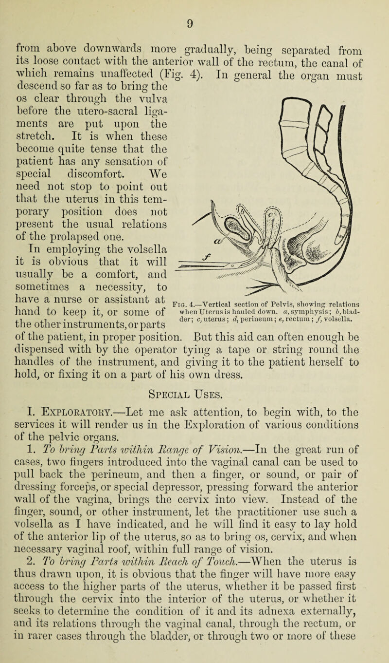 from above downwards more gradually, being separated from its loose contact with the anterior wall of the rectum, the canal of which remains unaffected (Fig. 4). In general the organ must descend so far as to bring the os clear through the vulva before the utero-sacral liga- ments are put upon the stretch. It is when these become quite tense that the patient has any sensation of special discomfort. We need not stop to point out that the uterus in this tem¬ porary position does not present the usual relations of the prolapsed one. In employing the volsella it is obvious that it will usually be a comfort, and sometimes a necessity, to have a nurse or assistant at hand to keep it, or some of the other instruments, or parts of the patient, in proper position. But this aid can often enough be dispensed with by the operator tying a tape or string round the handles of the instrument, and giving it to the patient herself to hold, or fixing it on a part of his own dress. Special Uses. Fig. 4.—Vertical section of Pelvis, showing relations when Uterus is hauled down, a, symphysis; ^blad¬ der; c, uterus; d, perineum; e, rectum ; f, volsella. I. Exploratory.—Let me ask attention, to begin with, to the services it will render us in the Exploration of various conditions of the pelvic organs. 1. To bring Parts within Range of Vision.—In the great run of cases, two fingers introduced into the vaginal canal can be used to pull back the perineum, and then a finger, or sound, or pair of dressing forceps, or special depressor, pressing forward the anterior wall of the vagina, brings the cervix into view. Instead of the finger, sound, or other instrument, let the practitioner use such a volsella as I have indicated, and he will find it easy to lay hold of the anterior lip of the uterus, so as to bring os, cervix, and when necessary vaginal roof, within full range of vision. 2. To bring Parts within Reach of Touch.—When the uterus is thus drawn upon, it is obvious that the finger will have more easy access to the higher parts of the uterus, whether it be passed first through the cervix into the interior of the uterus, or whether it seeks to determine the condition of it and its adnexa externally, and its relations through the vaginal canal, through the rectum, or in rarer cases through the bladder, or through two or more of these