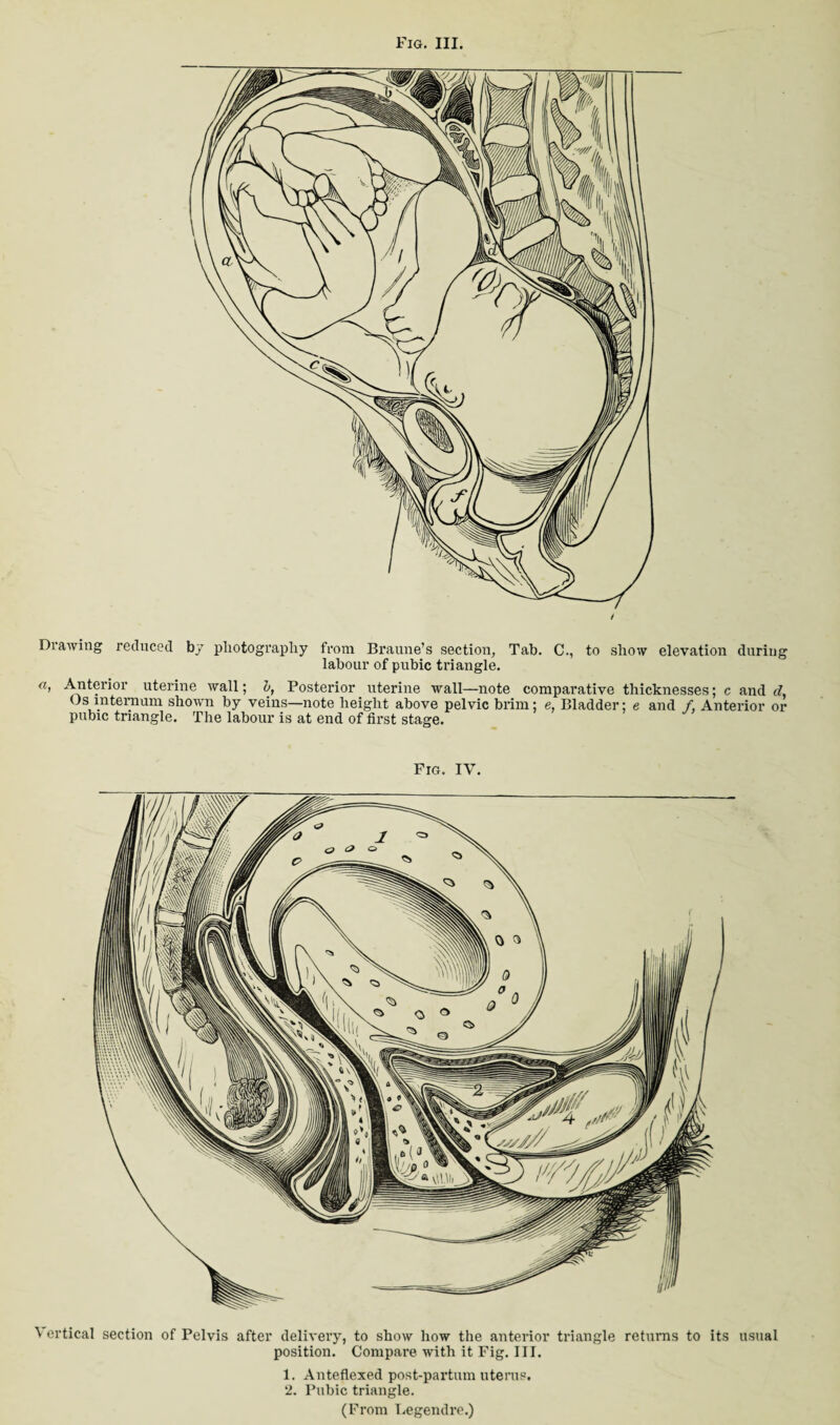 Drawing reduced by photography from Braune’s section, Tab. C., to show elevation during labour of pubic triangle. a, Anterior uterine wall; o, Posterior uterine Avail—note comparative thicknesses; c and d, Os internum shown by veins—note height above pelvic brim; e. Bladder; e and /. Anterior or pubic triangle. The labour is at end of first stage. Fig. IV. Vertical section of Pelvis after delivery, to show how the anterior triangle returns to its usual position. Compare with it Fig. III. 1. Anteflexed post-partum uterus. 2. Pubic triangle. (From Legendre.)