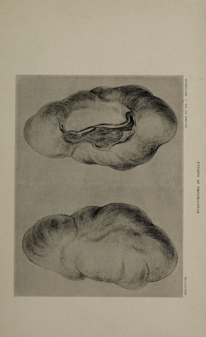 MYXO-FIBROMA OF AURICLE.