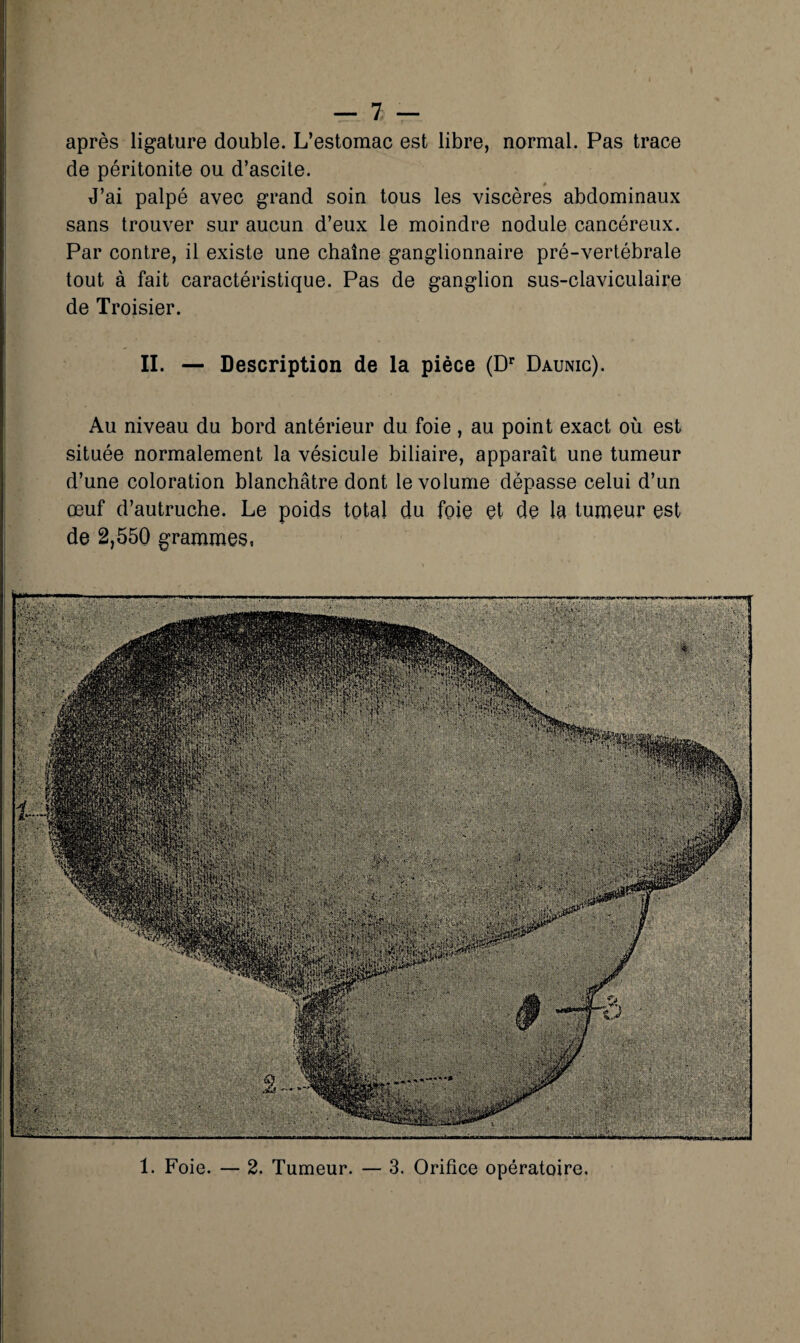 après ligature double. L’estomac est libre, normal. Pas trace de péritonite ou d’ascite. J’ai palpé avec grand soin tous les viscères abdominaux sans trouver sur aucun d’eux le moindre nodule cancéreux. Par contre, il existe une chaîne ganglionnaire pré-vertébrale tout à fait caractéristique. Pas de ganglion sus-claviculaire de Troisier. II. — Description de la pièce (D Daunic). Au niveau du bord antérieur du foie, au point exact où est située normalement la vésicule biliaire, apparaît une tumeur d’une coloration blanchâtre dont le volume dépasse celui d’un œuf d’autruche. Le poids total du foie et de la tumeur est de 2,550 grammes. P » .Kj.-*-: rWMfiQiwriwjiiiBaiMI 1. Foie. — 2. Tumeur. — 3. Orifice opératoire