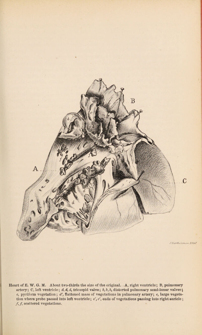 Heart of E. W. G. M. About two-thirds the size of the original. -A, right ventricle; B, pulmonary artery; C, left ventricle; d. d, d, tricuspid valve; b, b, b, distorted pulmonary semi-lunar valves; c, pyriform vegetation; d% flattened mass of vegetations in pulmonary artery; e, large vegeta¬ tion where probe passed into left ventricle; e', e', ends of vegetations passing into right auricle; /, /, scattered vegetations.