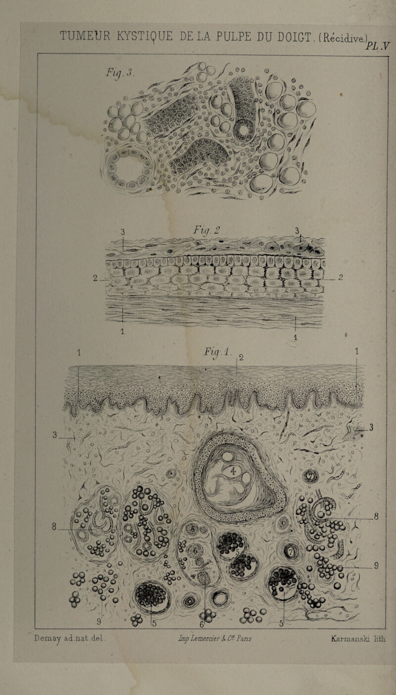 TUMEUR KYSTIQUE DELA PULPE DU DOIGT. (Récidive.) PL .V Demaj ad.nat.del. lmp Le mercier k C- Fans Karmanski lith g ,, Fin . i. » C. S° T 4 O °sê