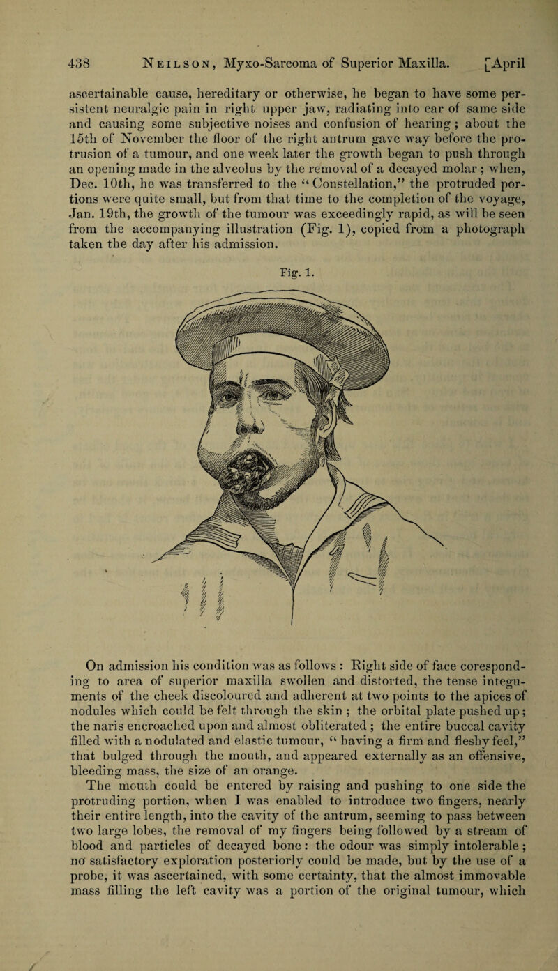 ascertainable cause, hereditary or otherwise, he began to have some per¬ sistent neuralgic pain in right upper jaw, radiating into ear of same side and causing some subjective noises and confusion of hearing ; about the 15th of November the floor of the right antrum gave way before the pro¬ trusion of a tumour, and one week later the growth began to push through an opening made in the alveolus by the removal of a decayed molar ; when, Dec. 10th, he was transferred to the “ Constellation,” the protruded por¬ tions were quite small, but from that time to the completion of the voyage, Jan. 19th, the growth of the tumour was exceedingly rapid, as will be seen from the accompanying illustration (Fig. 1), copied from a photograph taken the day after his admission. Fig. 1. On admission his condition was as follows : Right side of face corespond¬ ing to area of superior maxilla swollen and distorted, the tense integu¬ ments of the cheek discoloured and adherent at two points to the apices of nodules which could be felt through the skin ; the orbital plate pushed up; the naris encroached upon and almost obliterated ; the entire buccal cavity filled with a nodulated and elastic tumour, “ having a firm and fleshy feel,” that bulged through the mouth, and appeared externally as an offensive, bleeding mass, the size of an orange. The mouth could be entered by raising and pushing to one side the protruding portion, when I was enabled to introduce two fingers, nearly their entire length, into the cavity of the antrum, seeming to pass between two large lobes, the removal of my fingers being followed by a stream of blood and particles of decayed bone: the odour was simply intolerable; no satisfactory exploration posteriorly could be made, but by the use of a probe, it was ascertained, with some certainty, that the almost immovable mass filling the left cavity was a portion of the original tumour, which