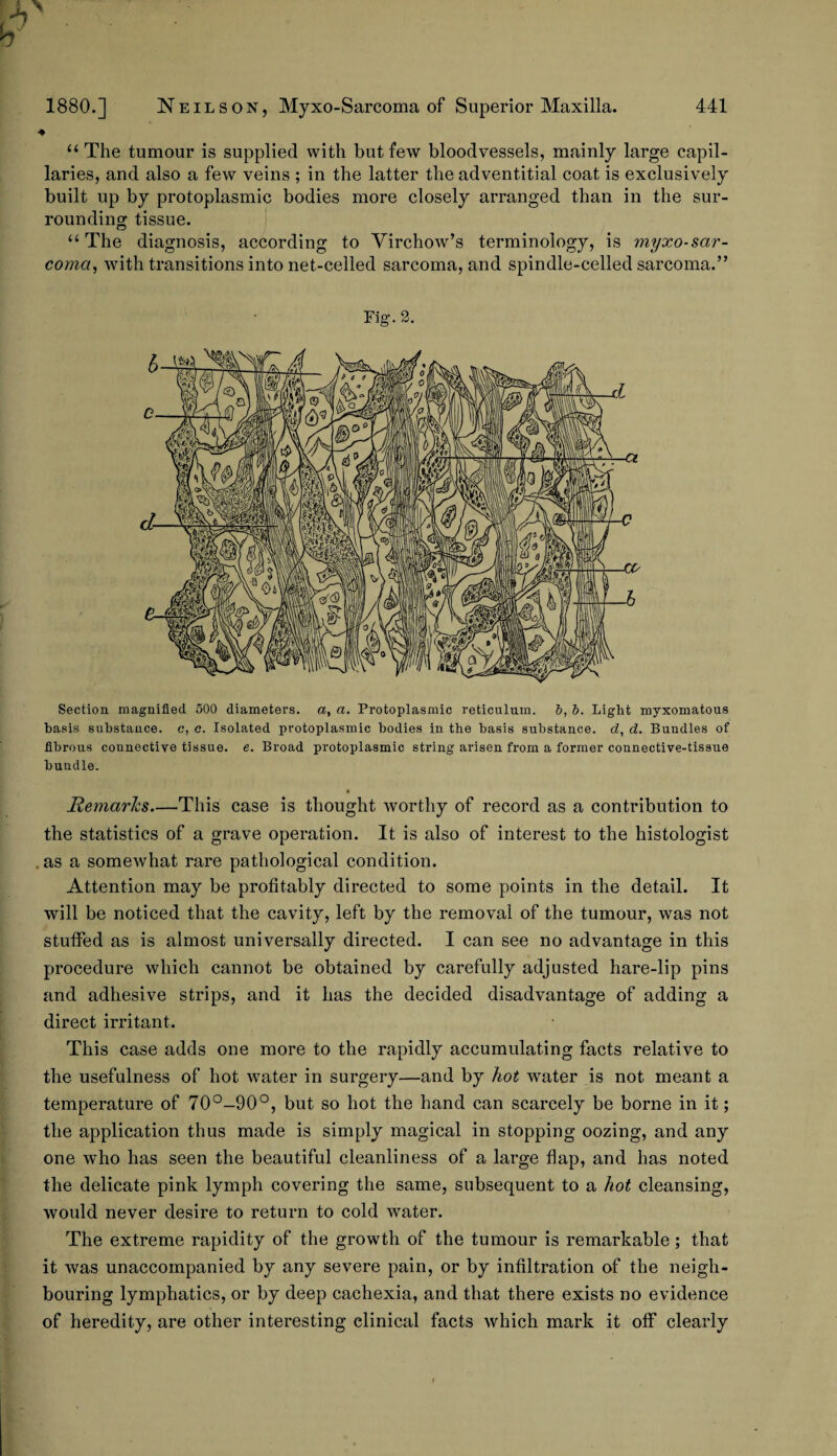 ► “ The tumour is supplied with but few bloodvessels, mainly large capil¬ laries, and also a few veins ; in the latter the adventitial coat is exclusively built up by protoplasmic bodies more closely arranged than in the sur¬ rounding tissue. “The diagnosis, according to Virchow’s terminology, is myxo-sar- comct, with transitions into net-celled sarcoma, and spindle-celled sarcoma.” Fig. 2. Section magnified 500 diameters, a, a. Protoplasmic reticulum. 5, b. Light myxomatous basis substance, c, o. Isolated protoplasmic bodies in the basis substance, d, d. Bundles of fibrous connective tissue, e. Broad protoplasmic string arisen from a former connective-tissue bundle. Remarks—This case is thought worthy of record as a contribution to the statistics of a grave operation. It is also of interest to the histologist as a somewhat rare pathological condition. Attention may be profitably directed to some points in the detail. It will be noticed that the cavity, left by the removal of the tumour, was not stuffed as is almost universally directed. I can see no advantage in this procedure which cannot be obtained by carefully adjusted hare-lip pins and adhesive strips, and it has the decided disadvantage of adding a direct irritant. This case adds one more to the rapidly accumulating facts relative to the usefulness of hot water in surgery—and by hot waiter is not meant a temperature of 70°-90°, but so hot the hand can scarcely be borne in it; the application thus made is simply magical in stopping oozing, and any one who has seen the beautiful cleanliness of a large flap, and has noted the delicate pink lymph covering the same, subsequent to a hot cleansing, would never desire to return to cold water. The extreme rapidity of the growth of the tumour is remarkable ; that it was unaccompanied by any severe pain, or by infiltration of the neigh¬ bouring lymphatics, or by deep cachexia, and that there exists no evidence of heredity, are other interesting clinical facts which mark it off clearly