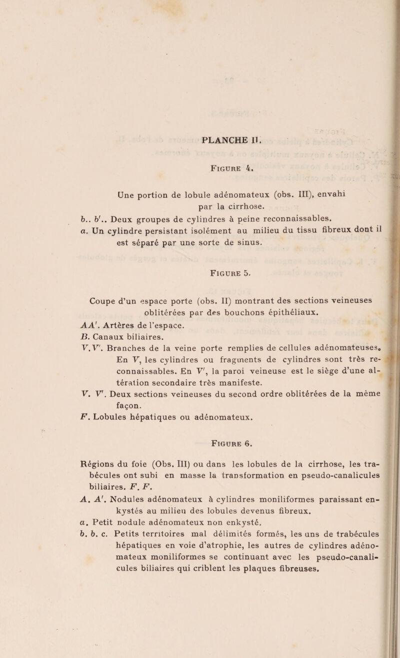 Figure 4. Une portion de lobule adénomateux (obs. III), envahi par la cirrhose. b.. b'.. Deux groupes de cylindres à peine reconnaissables. a. Un cylindre persistant isolément au milieu du tissu fibreux dont il est séparé par une sorte de sinus. Figure 5. Coupe d’un espace porte (obs. II) montrant des sections veineuses oblitérées par des bouchons épithéliaux. AA'. Artères de l’espace. B. Canaux biliaires. V.V. Branches de la veine porte remplies de cellules adénomateuses,. En F, les cylindres ou fragments de cylindres sont très re¬ connaissables. En Y', la paroi veineuse est le siège d’une al¬ tération secondaire très manifeste. V. V'. Deux sections veineuses du second ordre oblitérées de la même façon. F. Lobules hépatiques ou adénomateux. Figure 6. Régions du foie (Obs. III) ou dans les lobules de la cirrhose, les tra¬ bécules ont subi en masse la transformation en pseudo-canalicules biliaires. F. F. A. A'. Nodules adénomateux à cylindres moniliformes paraissant en¬ kystés au milieu des lobules devenus fibreux. a. Petit nodule adénomateux non enkysté. b. b. c. Petits territoires mal délimités formés, les uns de trabécules hépatiques en voie d’atrophie, les autres de cylindres adéno¬ mateux moniliformes se continuant avec les pseudo-canali¬ cules biliaires qui criblent les plaques fibreuses.