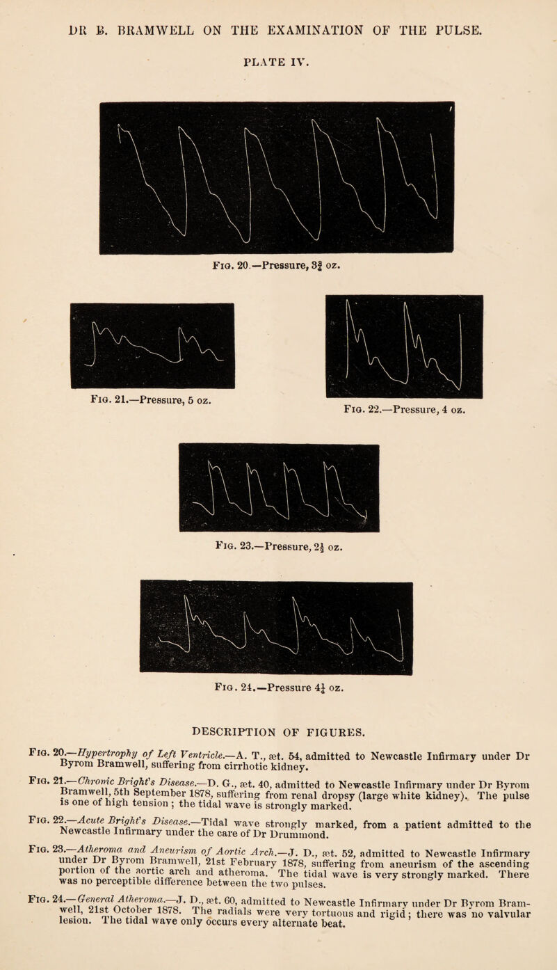 PLATE IV. Fig. 20 —Pressure, 3f oz. Fig. 21.—Pressure, 5 oz. Fig. 22.—Pressure, 4 oz. Fig. 23.—Pressure, 2£ oz. Fig. 24.—Pressure 4J oz. DESCRIPTION OF FIGURES. Fla.*!®,—-Hypertrophy of Left Ventricle.—A. T., set. 54, admitted to Newcastle Infirmary under Dr Byrom Bramwell, suffering from cirrhotic kidney. Fig. 21. Chronic Bright's Disease.-—D. G., set. 40, admitted to Newcastle Infirmary under Dr Byrom Bramwell, 5th September 1878, suffering from renal dropsy (large white kidney). The pulse is one of high tension ; the tidal wave is strongly marked. Fig. 22.—Acute Bright's Disease.—Tidal wave strongly marked, from a patient admitted to the Newcastle Infirmary under the care of Dr Drummond. Fig. 23.—Atheronia and Aneurism of Aortic Arch.—J. D., pet. 52, admitted to Newcastle Infirmary under Di Byiom Bramwell, 21st February 1878, suffering from aneurism of the ascending poition ot the aortic arch and atheroma. The tidal wave is very strongly marked. There was no peiceptible difference between the two pulses. Fig. 2i.—-General Atheroma.—J. D. pet. 60, admitted to Newcastle Infirmary under Dr Byrom Brain- well, 2lst October 1878. 4 he radials were very tortuous and rigid: there was no valvular