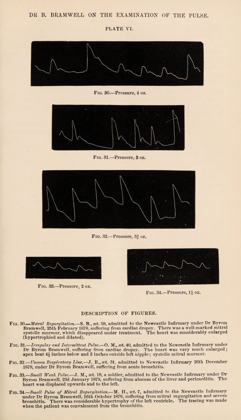 PLATE VI. Fig. 30.—Pressure, 4 oz. Fig. 31.—Pressure, 3 oz. Fig. 32.—Pressure, 3£ oz. Fig. 33.—Pressure, 2 oz. Fig. 34.—Pressure, I5 oz. DESCRIPTION OF FIGURES. Fig. 30.—Mitral Regurgitation.—S. B., set. 58, admitted to the Newcastle Infirmary under Dr Byrom Bramwell, 25th February 1878, suffering from cardiac dropsy. There was a well-marked mitral systolic murmur, which disappeared under treatment. The heart was considerably enlarged (hypertrophied and dilated). Fig. 31.—Irregular and Intermittent Pulse.—O. M., set. 40, admitted to the Newcastle Infirmary under Dr Byrom Bramwell, suffering from cardiac dropsy. The heart was very much enlarged ; apex beat 4£ inches below and 3 inches outside left nipple; systolic mitral murmur. Fig. 32.—Uneven Respiratory Line.—J. R., set. 31, admitted to Newcastle Infirmary 26th December 1878, under Dr Byrom Bramwell, suffering from acute bronchitis. Fig. 33.—Small Weak Pulse.—J. M., set. 18, a soldier, admitted to the Newcastle Infirmary under Dr Byrom Bramwell, 23d January 1879, suffering from abscess of the liver and pericarditis. The heart was displaced upwards and to the left. Fig. 34.—Small Pulse of Mitral Regurgitation.—M. H., set. 7, admitted to the Newcastle Infirmary under Dr Byrom Bramwell, 16th October 1878, suffering from mitral regurgitation and severe bronchitis. There was considerable hypertrophy of the left ventricle. The tracing was made when the patient was convalescent from the bronchitis.