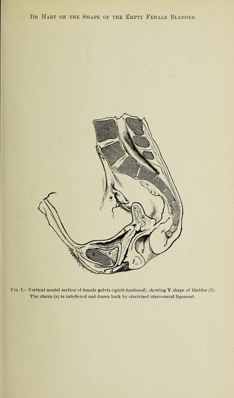 Fig. 1.—Vertical mesial section of female pelvis (spirit-hardened), showing Y shape of bladder (b). The uterus (a) is anteflexcd and drawn back by cicatrized utero-saeral ligament.