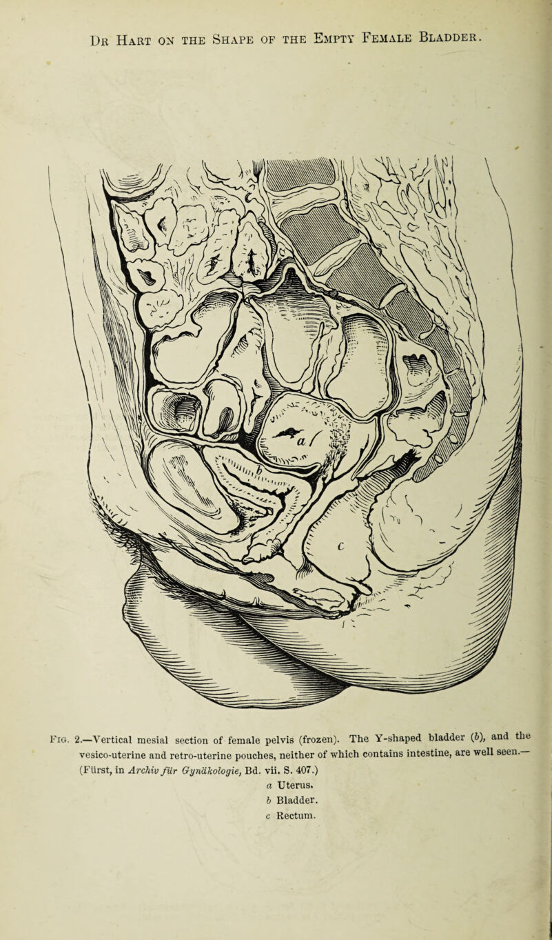 !.—Vertical mesial section of female pelvis (frozen). The Y-shaped bladder (b), and the vesico-uterine and retro-uterine pouches, neither of which contains intestine, are well seen. (Fiirst, in Archiv fur Gynakologie, Bd. vii. S. 407.) a Uterus. b Bladder. c Rectum.