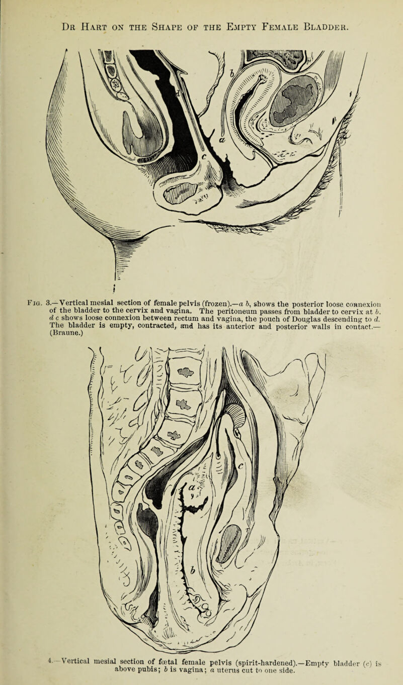 « » Fig. 3.—Vertical mesial section of female pelvis (frozen).—a b, shows the posterior loose connexion of the bladder to the cervix and vagina. The peritoneum passes from bladder to cervix at b. d c shows loose connexion between rectum and vagina, the pouch of Douglas descending to d. The bladder is empty, contracted, and has its anterior and posterior walls in contact.— (Braune.)