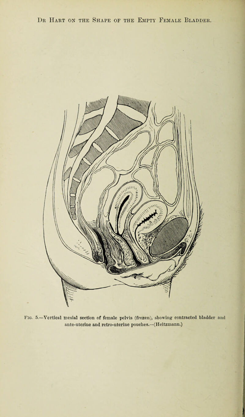 Fig. 5 .—Vertical mesial section of female pelvis (frozen), showing contracted bladder and ante-uterine and retro-uterine pouches.—(Heitzmann.)