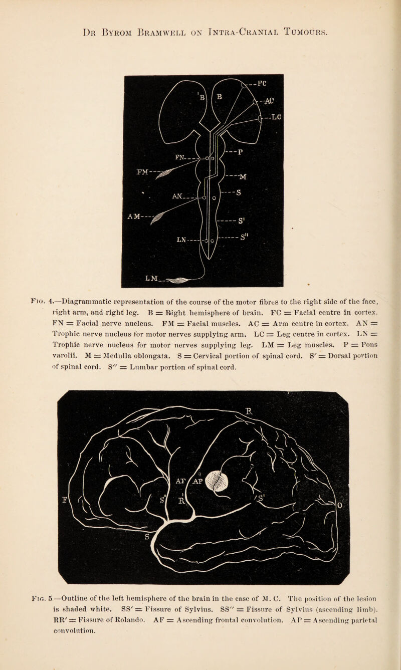 Fio. 4.—Diagrammatic representation of the course of the motor fibres to the right side of the face, right arm, and right leg. B = Right hemisphere of brain. FC = Facial centre in cortex. FN = Facial nerve nucleus. FM = Facial muscles. AC = Arm centre in cortex. AN = Trophic nerve nucleus for motor nerves supplying arm. LC = Leg centre in cortex. LN = Trophic nerve nucleus for motor nerves supplying leg. LM = Leg muscles. P = Pons varolii. M = Medulla oblongata. S = Cervical portion of spinal cord. S'= Dorsal portion of spinal cord. S = Lumbar portion of spinal cord. Fig. 5 —Outline of the left hemisphere of the brain in the case of M. C. The position of the lesion is shaded white. SS' = Fissure of Sylvius. SS = Fissure of Sylvius (ascending limb). RR' = Fissure of Rolando. AF = Ascending frontal convolution. AP = Ascending parietal convolution.