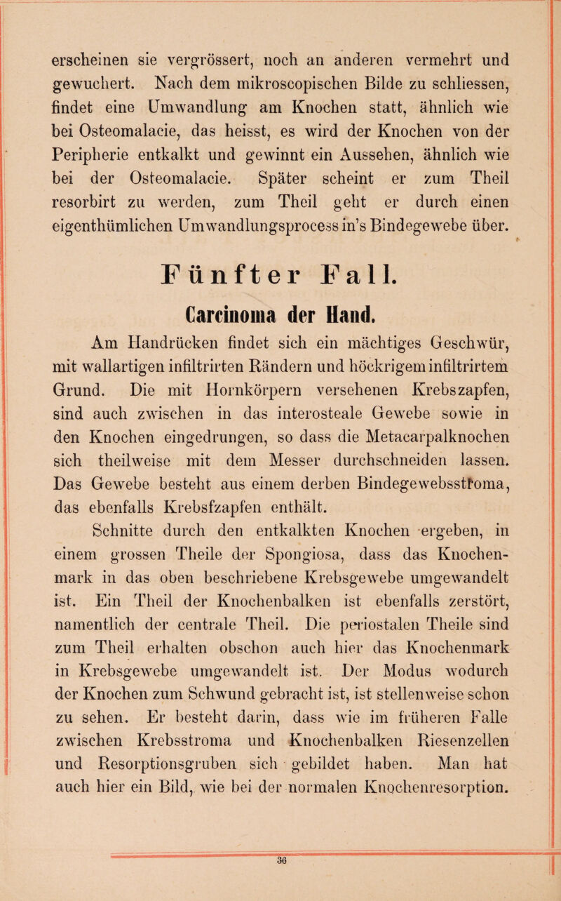 erscheinen sie vergrössert, noch an anderen vermehrt und gewuchert. Nach dem mikroscopischen Bilde zu schlossen, findet eine Umwandlung am Knochen statt, ähnlich wie bei Osteomalacie, das heisst, es wird der Knochen von der Peripherie entkalkt und gewinnt ein Aussehen, ähnlich wie bei der Osteomalacie. Später scheint er zum Theil resorbirt zu werden, zum Theil geht er durch einen eigentümlichen Umwandlungsprocessin’s Bindegewebe über. Fünfter Fall. Carcinoma der Hand. Am Handrücken findet sich ein mächtiges Geschwür, mit wallartigen infiltrirten Rändern und höckrigeminfiltrirtem Grund. Die mit Hornkörpern versehenen Krebs zapfen, sind auch zwischen in das interosteale Gewebe sowie in den Knochen eingedrungen, so dass die Metacarpalknochen sich teilweise mit dem Messer durchschneiden lassem Das Gewebe besteht aus einem derben Bindege websstfoma, das ebenfalls Krebsfzapfen enthält. Schnitte durch den entkalkten Knochen ergeben, in einem grossen Theile der Spongiosa, dass das Knochen¬ mark in das oben beschriebene Krebsgewebe umgewandelt ist. Ein Theil der Knochenbalken ist ebenfalls zerstört, namentlich der centrale Theil. Die periostalen Theile sind zum Theil erhalten obschon auch hier das Knochenmark in Krebsgewebe umgewandelt ist. Der Modus wodurch der Knochen zum Schwund gebracht ist, ist stellenweise schon zu sehen. Er besteht darin, dass wie im früheren Falle zwischen Krebsstroma und Knochenbalken Riesenzellen und Resorptionsgruben sich gebildet haben. Man hat auch hier ein Bild, wie bei der normalen Knochenresorption.