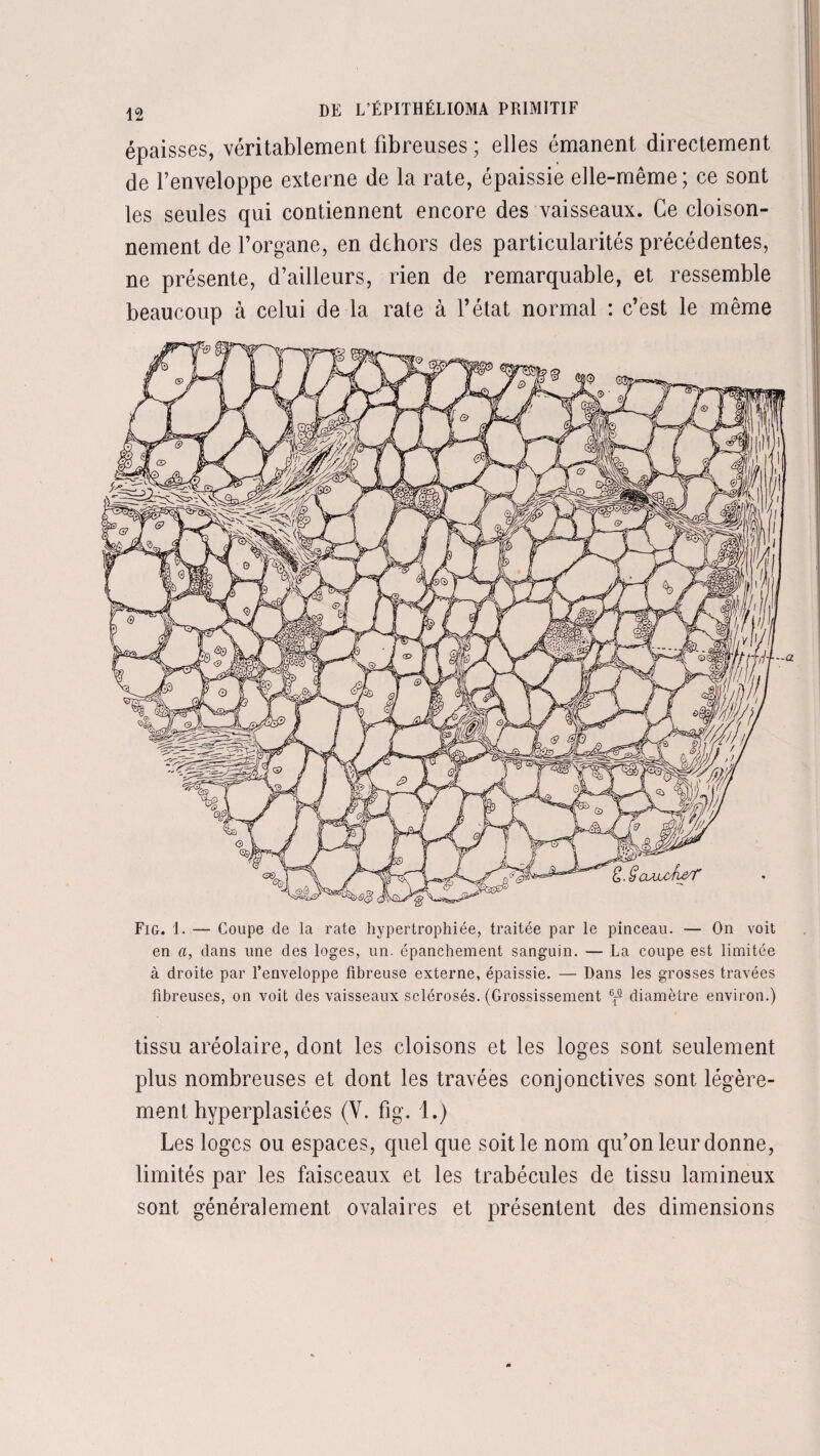 épaisses, véritablement fibreuses ; elles émanent directement de l’enveloppe externe de la rate, épaissie elle-même; ce sont les seules qui contiennent encore des vaisseaux. Ce cloison¬ nement de l’organe, en dehors des particularités précédentes, ne présente, d’ailleurs, rien de remarquable, et ressemble beaucoup à celui de la rate à l’état normal : c’est le même Fig. 1. — Coupe de la rate hypertrophiée, traitée par le pinceau. — On voit en a, dans une des loges, un. épanchement sanguin. — La coupe est limitée à droite par l’enveloppe fibreuse externe, épaissie. — Dans les grosses travées fibreuses, on voit des vaisseaux sclérosés. (Grossissement 6jr diamètre environ.) tissu aréolaire, dont les cloisons et les loges sont seulement plus nombreuses et dont les travées conjonctives sont légère¬ ment hyperplasiées (Y. fig. 1.) Les loges ou espaces, quel que soit le nom qu’on leur donne, limités par les faisceaux et les trabécules de tissu lamineux sont généralement ovalaires et présentent des dimensions