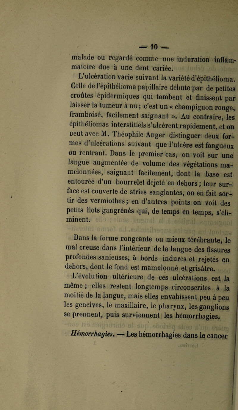 mâlade ou regardé comme une induration inflam¬ matoire due à une dent cariée. L’ulcération varie suivant la variété d’épithélioma. Celle del’épithélioma papillaire débute par de petites croûtes épidermiques qui tombent et finissent par laisser la tumeur à nu ; c est un « champignon rouge, framboisé, facilement saignant ». Au contraire, les épithéliomas interstitiels s’ulcèrent rapidement, et on peut avec M. Théophile Anger distinguer deux for¬ mes d ulcérations suivant que l’ulcère est fongueux ou rentrant. Dans le premier cas, on voit sur une langue augmentée de volume des végétations ma¬ melonnées, saignant facilement, dont la base est entourée d un bourrelet déjeté en dehors ; leur sur¬ face est couverte de stries sanglantes, on en fait sor¬ tir des vermiothes ; en d’autres points on voit des petits îlots gangrénés qui, de temps en temps, s’éli¬ minent. Dans la forme rongeante ou mieux térébrante, le mal creuse dans l’intérieur de la langue des fissures profondes sanieuses, à bords indurés et rejetés en dehors, dont le fond est mamelonné et grisâtre. L’évolution ultérieure de ces ulcérations est la même ; elles restent longtemps circonscrites à la moitié de la langue, mais elles envahissent peu à peu les gencives, le maxillaire, le pharynx, les ganglions se prennent, puis surviennent les hémorrhagies. i ; ; ' ' '; , ’ ' ' 1 ) • . O t . ; . ' f\ i \i î * 1 1■ r* i ■ V 1 * I Hémorrhagies. — Les hémorrhagies dans le cancer