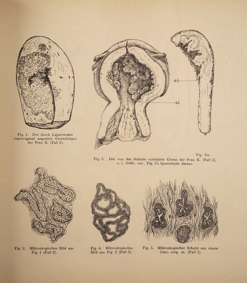 Fig. 3 a. Fig. 3. Der von der Scheide exstirpirte Uterus der Frau K. (Fall 3), o. i. Orific. ext., Fig. 3 a Querschnitt daraus.