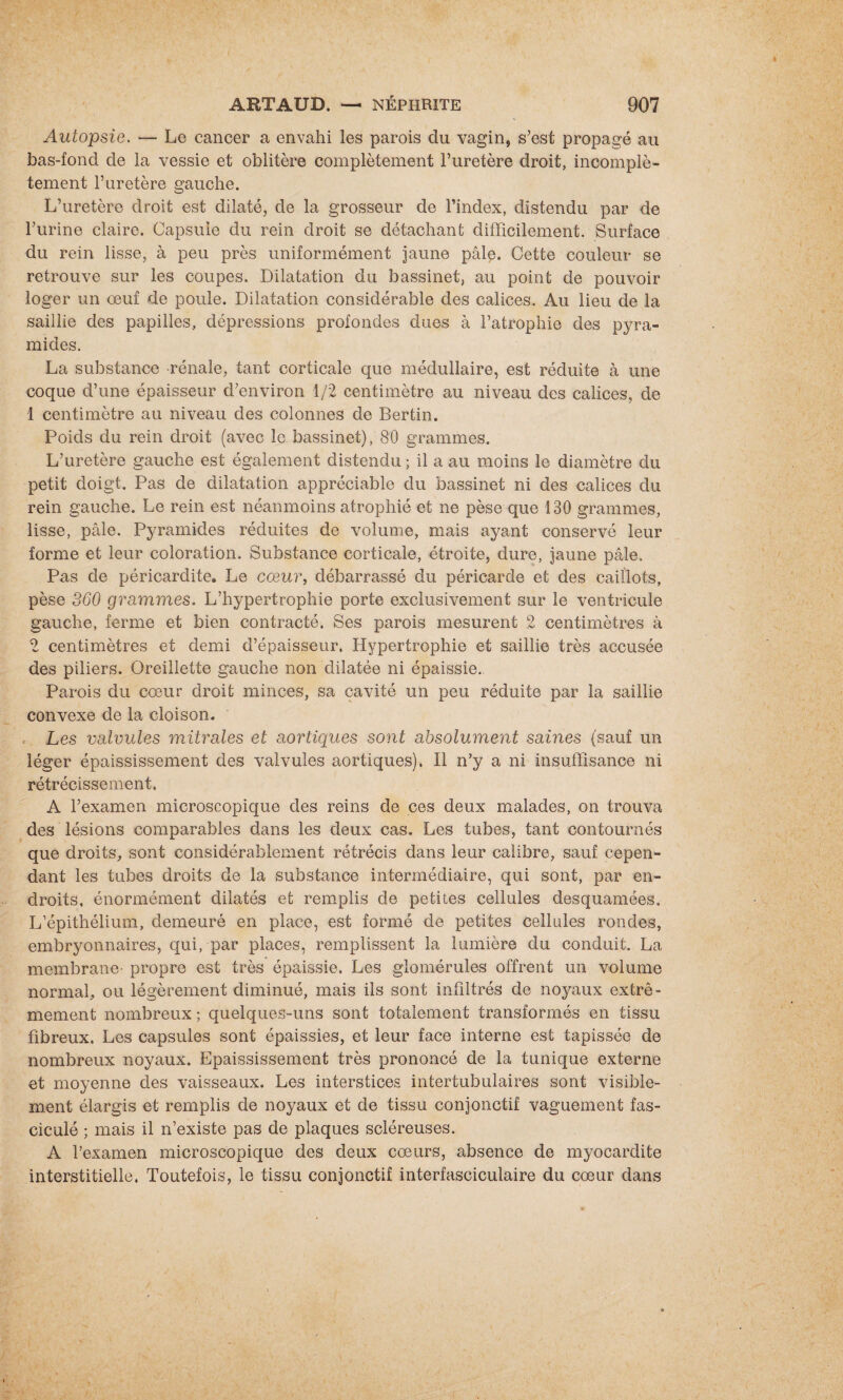 Autopsie. — Le cancer a envahi les parois du vagin, s’est propagé au bas-fond de la vessie et oblitère complètement l’uretère droit, incomplè¬ tement l’uretère gauche. L’uretère droit est dilaté, de la grosseur de l’index, distendu par de l’urine claire. Capsule du rein droit se détachant difficilement. Surface du rein lisse, à peu près uniformément jaune pâle. Cette couleur se retrouve sur les coupes. Dilatation du bassinet, au point de pouvoir loger un œuf de poule. Dilatation considérable des calices. Au lieu de la saillie des papilles, dépressions profondes dues à l’atrophie des pyra¬ mides. La substance rénale, tant corticale que médullaire, est réduite à une coque d’une épaisseur d’environ 1/2 centimètre au niveau des calices, de 1 centimètre au niveau des colonnes de Bertin. Poids du rein droit (avec le bassinet), 80 grammes. L’uretère gauche est également distendu ; il a au moins le diamètre du petit doigt. Pas de dilatation appréciable du bassinet ni des calices du rein gauche. Le rein est néanmoins atrophié et ne pèse que 130 grammes, lisse, pâle. Pyramides réduites de volume, mais ayant conservé leur forme et leur coloration. Substance corticale, étroite, dure, jaune pâle. Pas de péricardite. Le cœur, débarrassé du péricarde et des caillots, pèse 360 grammes. L’hypertrophie porte exclusivement sur le ventricule gauche, ferme et bien contracté. Ses parois mesurent 2 centimètres à 2 centimètres et demi d’épaisseur. Hypertrophie et saillie très accusée des piliers. Oreillette gauche non dilatée ni épaissie. Parois du cœur droit minces, sa cavité un peu réduite par la saillie convexe de la cloison. Les valvules mitrales et aortiques sont absolument saines (sauf un léger épaississement des valvules aortiques). Il n’y a ni insuffisance ni rétrécissement. A l’examen microscopique des reins de ces deux malades, on trouva des lésions comparables dans les deux cas. Les tubes, tant contournés que droits, sont considérablement rétrécis dans leur calibre, sauf cepen¬ dant les tubes droits de la substance intermédiaire, qui sont, par en¬ droits, énormément dilatés et remplis de petites cellules desquamées. L’épithélium, demeuré en place, est formé de petites cellules rondes, embryonnaires, qui, par places, remplissent la lumière du conduit. La membrane propre est très épaissie. Les glomérules offrent un volume normal, ou légèrement diminué, mais ils sont infiltrés de noyaux extrê¬ mement nombreux ; quelques-uns sont totalement transformés en tissu fibreux. Les capsules sont épaissies, et leur face interne est tapissée de nombreux noyaux. Epaississement très prononcé de la tunique externe et moyenne des vaisseaux. Les interstices intertubulaires sont visible¬ ment élargis et remplis de noyaux et de tissu conjonctif vaguement fas- ciculé ; mais il n’existe pas de plaques scléreuses. A l’examen microscopique des deux cœurs, absence de myocardite interstitielle. Toutefois, le tissu conjonctif interfasciculaire du cœur dans