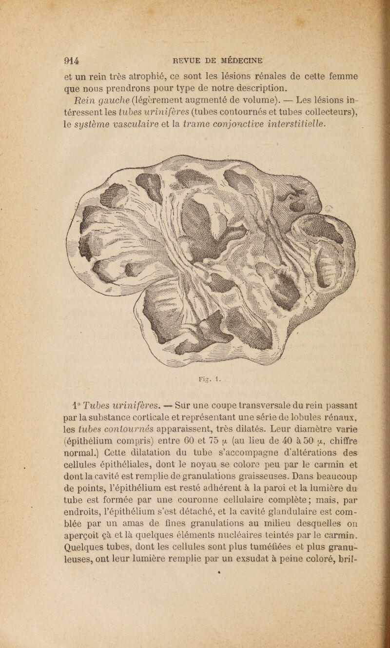et un rein très atrophié, ce sont les lésions rénales de cette femme que nous prendrons pour type de notre description. Rein gauche (légèrement augmenté de volume). — Les lésions in téressent les tubes urinifères (tubes contournés et tubes collecteurs), le système vasculaire et la trame conjonctive interstitielle. Fi-. 1. 1° Tubes urinifères. — Sur une coupe transversale du rein passant par la substance corticale et représentant une série de lobules rénaux, les tubes contournés apparaissent, très dilatés. Leur diamètre varie (épithélium compris) entre 60 et 75 g (au lieu de 40 à 50 [x, chiffre normal.) Cette dilatation du tube s’accompagne d’altérations des cellules épithéliales, dont le noyau se colore peu par le carmin et dont la cavité est remplie de granulations graisseuses. Dans beaucoup de points, l’épithélium est resté adhérent à la paroi et la lumière du tube est formée par une couronne cellulaire complète; mais, par endroits, l’épithélium s’est détaché, et la cavité glandulaire est com¬ blée par un amas de fines granulations au milieu desquelles on aperçoit çà et là quelques éléments nucléaires teintés par le carmin. Quelques tubes, dont les cellules sont plus tuméfiées et plus granu¬ leuses, ont leur lumière remplie par un exsudât à peine coloré, bril-