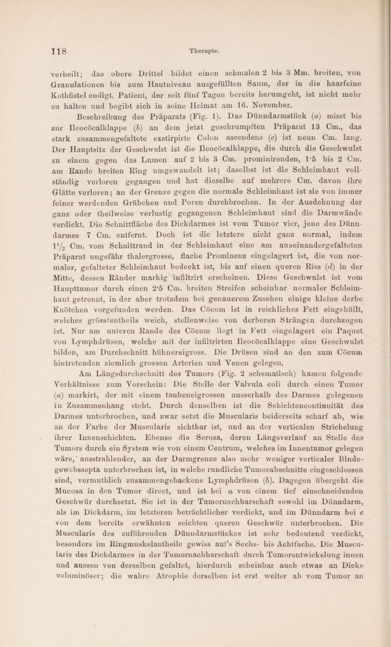 verheilt; das obere Drittel bildet eiuen schmalen 2 bis 3 Mm. breiten, von Granulationen bis zum Hautniveau ausgefüllten Saum, der in die haarfeine Kothfistel endigt. Patient, der seit fünf Tagen bereits herumgeht, ist nicht mehr zu halten und begibt sich in seine Heimat am 16. November. Beschreibung des Präparats (Fig. 1). Das Dünndarmstück (a) misst bis zur lleocöcalklappe (h) an dem jetzt geschrumpften Präparat 13 Cm., das stark zusammengefaltete exstirpirte Colon ascendens (c) ist neun Cm. lang. Der Hauptsitz der Geschwulst ist die lleocöcalklappe, die durch die Geschwulst zu einem gegen das Lumen auf 2 bis 3 Cm. prominirenden, 1*5 bis 2 Cm. am Rande breiten Ring umgewandelt ist; daselbst ist die Schleimhaut voll¬ ständig verloren gegangen und hat dieselbe auf mehrere Cm. davon ihre Glätte verloren; an der Grenze gegen die normale Schleimhaut ist sie von immer feiner werdenden Grübchen und Poren durchbrochen. In der Ausdehnung der ganz oder theilweise verlustig gegangenen Schleimhaut sind die Darmwände verdickt. Die Schnittfläche des Dickdarmes ist vom Tumor vier, jene des Dünn¬ darmes 7 Cm. entfernt. Doch ist die letztere nicht ganz normal, indem 172 Cm. vom Schnittrand in der Schleimhaut eine am auseinandergefalteten Präparat ungefähr thalergrosse, flache Prominenz eingelagert ist, die von nor¬ maler, gefalteter Schleimhaut bedeckt ist, bis auf einen queren Riss (d) in der Mitte, dessen Ränder markig infiltrirt erscheinen. Diese Geschwulst ist vom Haupttumor durch einen 2*5 Cm. breiten Streifen scheinbar normaler Schleim¬ haut getrennt, in der aber trotzdem bei genauerem Zusehen einige kleine derbe Knötchen vorgefunden werden. Das Cöcum ist in reichliches Fett eingehüllt, welches grösstentheils weich, stellenweise von derberen Strängen durchzogen ist. Nur am unteren Rande des Cöcum liegt in Fett eingelagert ein Paquet von Lyraphdrüsen, welche mit der infiltrirten lleocöcalklappe eine Geschwulst bilden, am Durchschnitt hühnereigross. Die Drüsen sind an den zum Cöcum hintretenden ziemlich grossen Arterien und Venen gelegen. Am Längsdurchschnitt des Tumors (Fig. 2 schematisch) kamen folgende Verhältnisse zum Vorschein: Die Stelle der Valvula coli durch einen Tumor (a) markirt, der mit einem taubeneigrossen ausserhalb des Darmes gelegenen in Zusammenhang steht. Durch denselben ist die Schichtencontinuität des Darmes unterbrochen, und zwar setzt die Muscularis beiderseits scharf ab, wie an der Farbe der Muscularis sichtbar ist, und an der verticalen Strichelung ihrer Innenschichten. Ebenso die Serosa, deren Längsverlauf an Stelle des Tumors durch ein System wie von einem Centrum, welches im Innentumor gelegen wäre, ‘ ausstrahlender, an der Darmgrenze also mehr weniger verticaler Binde- gewebssepta unterbrochen ist, in welche rundliche Tumorabschnitte eingeschlossen sind, vermuthlich zusammengebackene Lymphdrüsen (5). Dagegen übergeht die Mucosa in den Tumor direct, und ist bei a von einem tief einschneidenden Geschwür durchsetzt. Sie ist in der Tumornachbarschaft sowohl im Dünndarm, als im Dickdarm, im letzteren beträchtlicher verdickt, und im Dünndarm bei c von dem bereits erwähnten seichten queren Geschwür unterbrochen. Die Muscularis des zuführeuden Dünudarmstückes ist sehr bedeutend verdickt, besonders im Ringmuskelantheile gewiss auf’s Sechs- bis Achtfache. Die Muscu¬ laris des Dickdarmes in der Tumornachbarschaft durch Tumorentwickelung innen und aussen von derselben gefaltet, hierdurch scheinbar auch etwas an Dicke voluminöser; die wahre Atrophie derselben ist erst weiter ab vom Tumor an