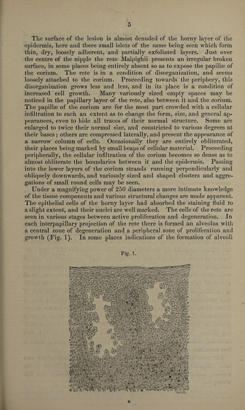 The surface of the lesion is almost denuded of the horny layer of the epidermis, here and there small islets of the same being seen which form thin, dry, loosely adherent, and partially exfoliated layers. Just over the centre of the nipple the rete Malpigliii presents an irregular broken surface, in some places being entirely absent so as to expose the papilke of the corium. The rete is in a condition of disorganization, and seems loosely attached to the corium. Proceeding towards the periphery, this disorganization grows less and less, and in its place is a condition of increased cell growth. Many variously sized empty spaces may be noticed in the papillary layer of the rete, also between it and the corium. The papillm of the corium are for the most part crowded with a cellular infiltration to such an extent as to change the form, size, and general ap¬ pearances, even to hide all traces of their normal structure. Some are enlarged to twice their normal size, and constricted to various degrees at their bases ; others are compressed laterally, and present the appearance of a narrow column of cells. Occasionally they are entirely obliterated, their places being marked by small heaps of cellular material. Proceeding peripherally, the cellular infiltration of the corium becomes so dense as to almost obliterate the boundaries between it and the epidermis. Passing into the lower layers of the corium strands running perpendicularly and obliquely downwards, and variously sized and shaped clusters and aggre¬ gations of small round cells may be seen. Under a magnifying power of 250 diameters a more intimate knowledge of the tissue components and various structural changes are made apparent. The epithelial cells of the horny layer had absorbed the staining fluid to a slight extent, and their nuclei are well marked. The cells of the rete are seen in various stages between active proliferation and degeneration. In each interpapillary projection of the rete there is formed an alveolus with a central zone of degeneration and a peripheral zone of proliferation and growth (Fig. 1). In some places indications of the formation of alveoli Fig. 1.