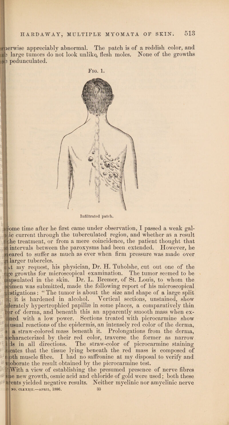 7T iB )»i lerwise appreciably abnormal. The patch is of a reddish color, and large tumors do not look unlike, flesh moles. None of the growths pedunculated. Fig. 1. Infiltrated patch. home time after he first came under observation, I passed a weak gal- Mic current through the tuberculated region, and whether as a result t e;he treatment, or from a mere coincidence, the patient thought that jU intervals between the paroxysms had been extended. However, he neared to suffer as much as ever when firm pressure was made over sp larger tubercles. n H my request, his physician, Dr. H. Tuholshe, cut out one of the ge growths for microscopical examination. The tumor seemed to be uapsulated in the skin. Dr. L. Bremer, of St. Louis, to whom the onimen was submitted, made the following report of his microscopical 'i nstigations: “ The tumor is about the size and shape of a large split bg; it is hardened in alcohol. Vertical sections, unstained, show \ lerately hypertrophied papillse in some places, a comparatively thin toir of derma, and beneath this an apparently smooth mass when ex- cjned with a low power. Sections treated with picrocarmine show yiusual reactions of the epidermis, an intensely red color of the derma, ; a straw-colored mass beneath it. Prolongations from the derma, : |j characterized by their red color, traverse the former as narrow is in all directions. The straw-color of picrocarmine staining cates that the tissue lying beneath the red mass is composed of ,oth muscle fibre. I had no saflronine at my disposal to verify and oborate the result obtained by the picrocarmine test. With a view of establishing the presumed presence of nerve fibres le new growth, osmic acid and chloride of gold were used; both these ents yielded negative results. Neither myelinic nor amyelinic nerve NO. CLXXXII,—APRIL, 1886. 33 IP