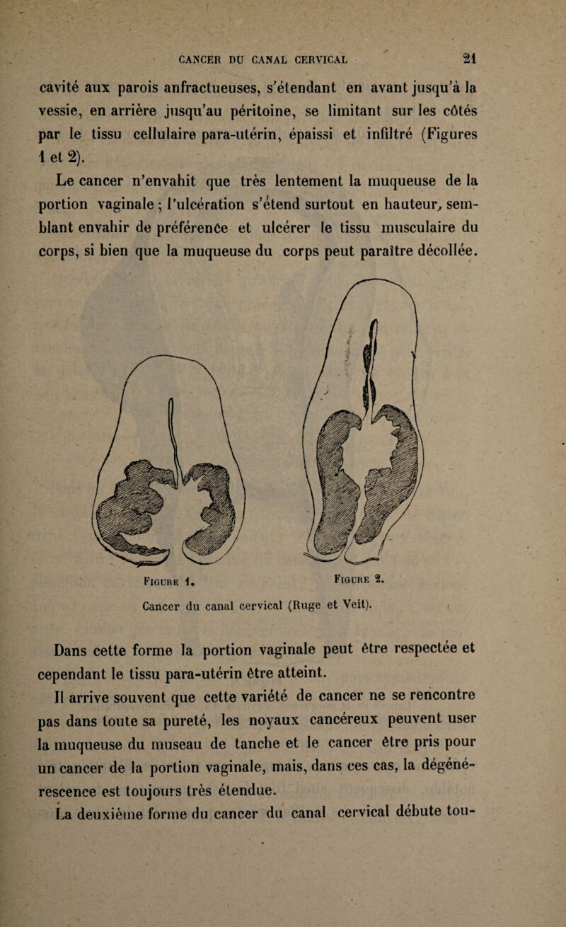 cavité aux parois anfractueuses, s’étendant en avant jusqu’à la vessie, en arrière jusqu’au péritoine, se limitant sur les côtés par le tissu cellulaire para-utérin, épaissi et infiltré (Figures 1 et 2). Le cancer n’envahit que très lentement la muqueuse de la portion vaginale ; l’ulcération s’étend surtout en hauteur, sem¬ blant envahir de préférence et ulcérer le tissu musculaire du corps, si bien que la muqueuse du corps peut paraître décollée. Cancer du canal cervical (Ruge et Veit). Dans cette forme la portion vaginale peut être respectée et cependant le tissu para-utérin être atteint. Jl arrive souvent que cette variété de cancer ne se rencontre pas dans toute sa pureté, les noyaux cancéreux peuvent user la muqueuse du museau de tanche et le cancer être pris pour un cancer de la portion vaginale, mais, dans ces cas, la dégéné¬ rescence est toujours très étendue. La deuxième forme du cancer du canal cervical débute tou-