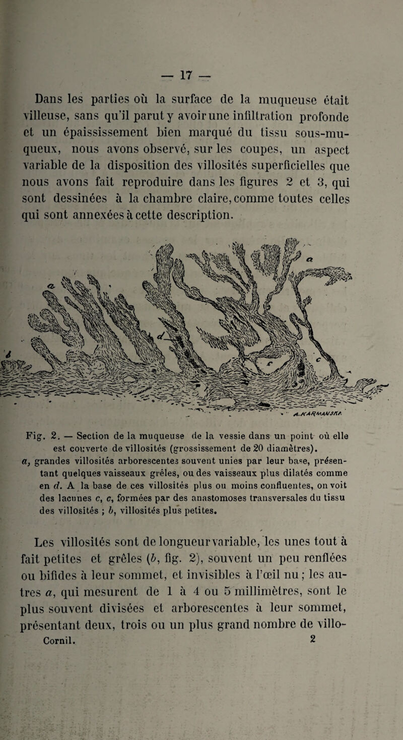 Dans les parties oil la surface de la muqueuse etait villeuse, sans qu’il paruty avoir une infiltration profoncle ct un epaississement bien marque du tissu sous-mu- queux, nous avons observe, sur les coupes, un aspect variable de la disposition des villosites superficielles que nous avons fait reproduire dans les figures 2 et 3, qui sont dessinees a la chambre claire, comme toutes cedes qui sont annexeesacette description. * ’ V A./CA/fMAVSAA Fig. 2. — Section de la muqueuse de la vessie dans un point ou elle est couverte de villosites (grossissement de 20 diametres). a, grandes villosites arborescentes souvent unies par leur base, pr^sen- tant quelques vaisseaux greles, oudes vaisseaux plus dilates comme en d. A la base de ces villosites plus ou moins confluentes, onvoit des lacunes c, c, formees par des anastomoses transversales du tissu des villosites ; b, villosites plus petites. * Les villosites sont de longueur variable, les unes tout a fait petites et greles (6, fig. 2), souvent un pcu renflees ou bifides a leur sommet, et invisibles a foeil nu; les au- tres a, qui mesurent de 1 a 4 ou 5 millimetres, sont le plus souvent divisees et arborescentes a leur sommet, presentant deux, trois ou un plus grand nombre de villo*- Cornil. 2