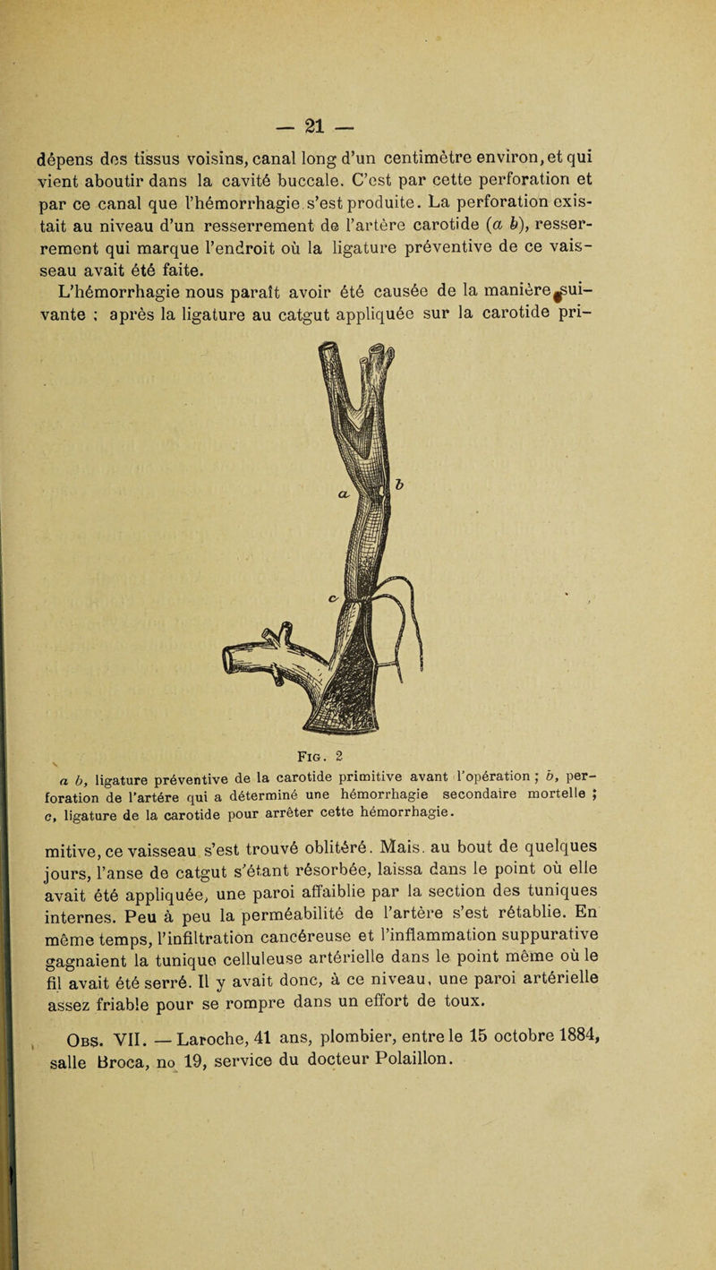 dépens des tissus voisins, canal long d’un centimètre environ, et qui vient aboutir dans la cavité buccale. C’est par cette perforation et par ce canal que l’hémorrhagie s’est produite. La perforation exis¬ tait au niveau d’un resserrement de l’artère carotide (a b), resser¬ rement qui marque l’endroit où la ligature préventive de ce vais¬ seau avait été faite. L’hémorrhagie nous paraît avoir été causée de la manière^ui- vante ; après la ligature au catgut appliquée sur la carotide pri- Fig. 2 V a b, ligature préventive de la carotide primitive avant l’opération ; b, per¬ foration de l’artére qui a déterminé une hémorrhagie secondaire mortelle ; c, ligature de la carotide pour arrêter cette hémorrhagie. mitive, ce vaisseau s’est trouvé oblitéré. Mais, au bout de quelques jours, l’anse de catgut s’étant résorbée, laissa dans le point où elle avait été appliquée, une paroi affaiblie par la section des tuniques internes. Peu à peu la perméabilité de l’artère s’est rétablie. En même temps, l’infiltration cancéreuse et l’inflammation suppurative gagnaient la tunique celluleuse artérielle dans le point même où le fil avait été serré. Il y avait donc, à ce niveau, une paroi artérielle assez friable pour se rompre dans un effort de toux. Obs. VII. — Laroche, 41 ans, plombier, entre le 15 octobre 1884, salle Broca, no 19, service du docteur Polaillon.