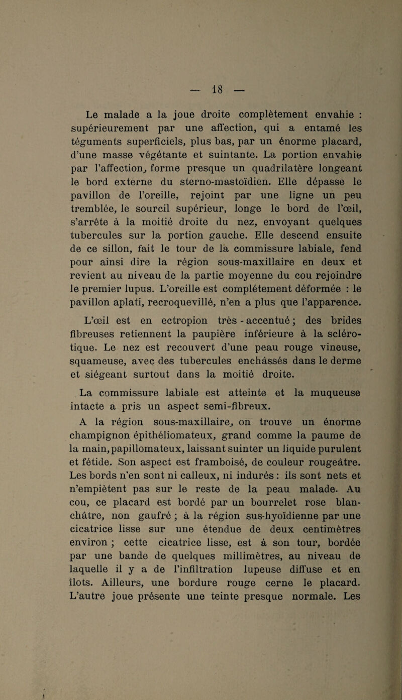 Le malade a la joue droite complètement envahie : supérieurement par une affection, qui a entamé les téguments superficiels, plus bas, par un énorme placard, d’une masse végétante et suintante. La portion envahie par l’affection, forme presque un quadrilatère longeant le bord externe du sterno-mastoïdien. Elle dépasse le pavillon de l’oreille, rejoint par une ligne un peu tremblée, le sourcil supérieur, longe le bord de l’œil, s’arrête à la moitié droite du nez, envoyant quelques tubercules sur la portion gauche. Elle descend ensuite de ce sillon, fait le tour de la commissure labiale, fend pour ainsi dire la région sous-maxillaire en deux et revient au niveau de la partie moyenne du cou rejoindre le premier lupus. L’oreille est complètement déformée : le pavillon aplati, recroquevillé, n’en a plus que l’apparence. L’œil est en ectropion très - accentué ; des brides fibreuses retiennent la paupière inférieure à la scléro¬ tique. Le nez est recouvert d’une peau rouge vineuse, squameuse, avec des tubercules enchâssés dans le derme et siégeant surtout dans la moitié droite. La commissure labiale est atteinte et la muqueuse intacte a pris un aspect semi-fibreux. A la région sous-maxillaire, on trouve un énorme champignon épithéliomateux, grand comme la paume de la main,papillomateux, laissant suinter un liquide purulent et fétide. Son aspect est framboisé, de couleur rougeâtre. Les bords n'en sont ni calleux, ni indurés : ils sont nets et n’empiètent pas sur le reste de la peau malade. Au cou, ce placard est bordé par un bourrelet rose blan¬ châtre, non gaufré ; à la région sus-hyoïdienne par une cicatrice lisse sur une étendue de deux centimètres environ ; cette cicatrice lisse, est à son tour, bordée par une bande de quelques millimètres, au niveau de laquelle il y a de l’infiltration lupeuse diffuse et en îlots. Ailleurs, une bordure rouge cerne le placard. L’autre joue présente une teinte presque normale. Les