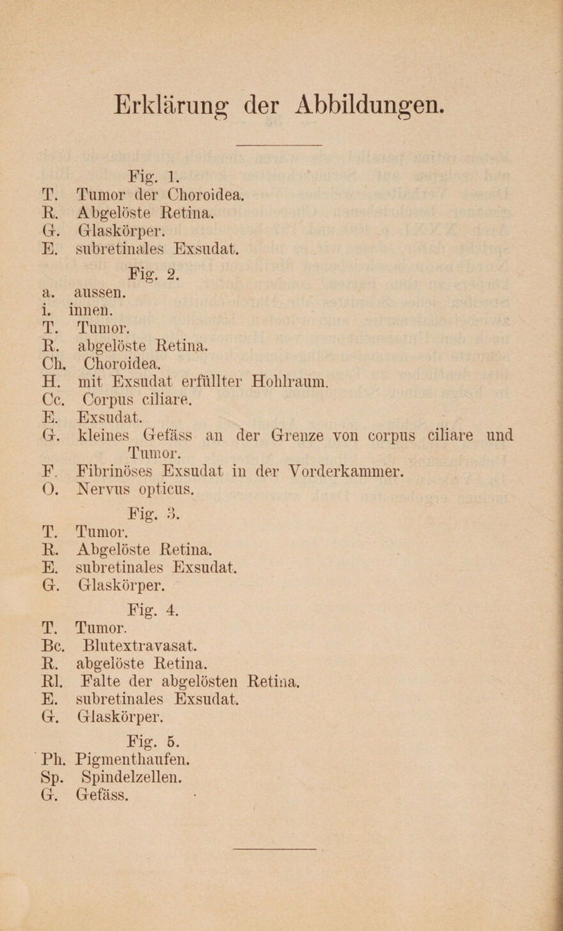 Erklärung der Abbildungen. Fig. 1. T. Tumor der Choroidea. R. Abgelöste Retina. G. Glaskörper. E. subretinales Exsudat. Fig. 2. a. aussen, i. innen. T. Tumor. R. abgelöste Retina. Ch. Choroidea. H. mit Exsudat erfüllter Hohlraum. Cc. Corpus ciliare. E. Exsudat. G. kleines Gefäss an der Grenze von corpus ciliare und Tumor. F. Fibrinöses Exsudat in der Vorderkammer. 0. Nervus opticus. Fig. 3. T. Tumor. R. Abgelöste Retina. E. subretinales Exsudat. G. Glaskörper. Fig. 4. T. Tumor. Bc. Blutextravasat. R. abgelöste Retina. RI. Falte der abgelösten Retina. E. subretinales Exsudat. G. Glaskörper. Fig. 5. Ph. Pigmenthaufen. Sp. Spindelzellen. G. Gefäss.