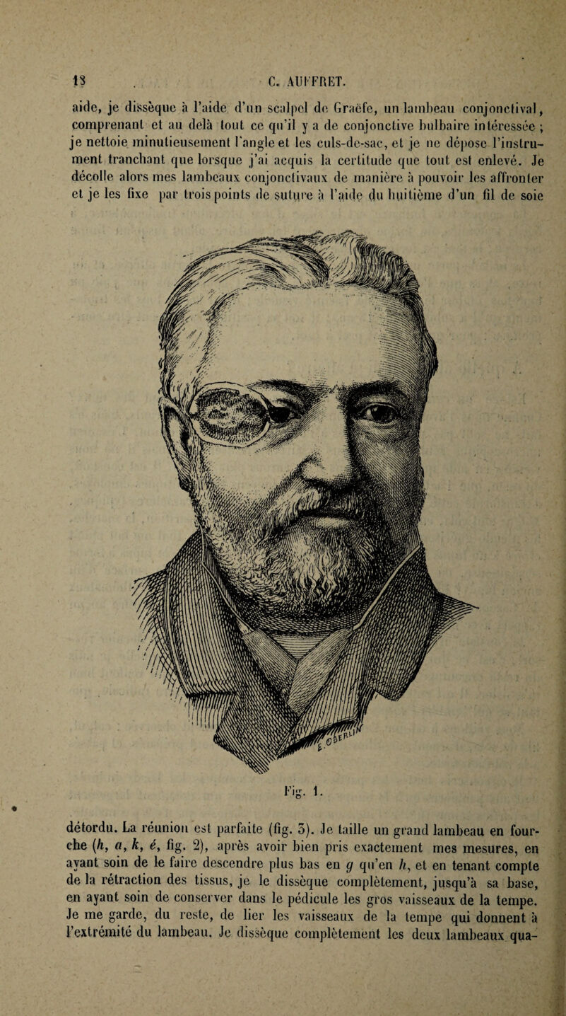 aide, je dissèque à l’aide d’un scalpel de Graëfc, un lambeau conjonctival, comprenant et au delà tout ce qu’il y a de conjonctive bulbaire intéressée ; je nettoie minutieusement l'angle et les culs-de-sac, et je ne dépose l’instru¬ ment tranchant que lorsque j’ai acquis la certitude que tout est enlevé. Je décolle alors mes lambeaux conjonctivaux de manière à pouvoir les affronter et je les fixe par trois points de suture à l’aide du huitième d’un fil de soie détordu. La réunion est parfaite (fig. 5). Je taille un grand lambeau en four¬ che (h, a, k, é, fig. 2), après avoir bien pris exactement mes mesures, en ayant soin de le faire descendre plus bas en g qu’en /<, et en tenant compte de la rétraction des tissus, je le dissèque complètement, jusqu’à sa base, en ayant soin de conserver dans le pédicule les gros vaisseaux de la tempe. Je me garde, du reste, de lier les vaisseaux de la tempe qui donnent à