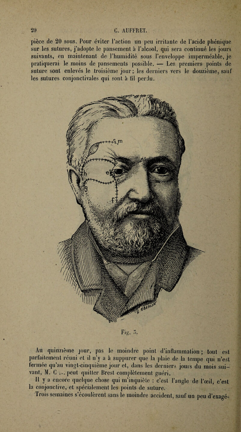pièce de 20 sous. Pour éviter l’action un peu irritante de l’acide phénique sur les sutures, j’adopte le pansement à l’alcool, qui sera continué les jours suivants, en maintenant de l’humidité sous l’enveloppe imperméable, je pratiquerai le moins de pansements possible. — Les premiers points de suture sont enlevés le troisième jour; les derniers vers le douzième, sauf les sutures conjonctivales qui sont à fil perdu. Fig. Au quinzième jour, pas le moindre point d’inflammation; tout est parfaitement réuni et il n'y a à suppurer que la plaie de la tempe qui n’est fermée qu’au vingt-cinquième jour et, dans les derniers jours du mois sui¬ vant, M. C ... peut quitter Brest complètement guéri. H y a encore quelque chose qui m’inquiète : c’est l’angle de l’œil, c’est la conjonctive, et spécialement les points de suture. Trois semaines s’écoulèrent sans le moindre accident, sauf un peu d’exagé-.