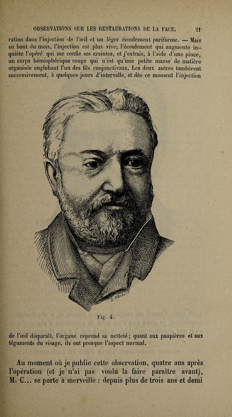 ration dans l’injection de l’œil et un léger écoulement puriforme. — Mais au bout du mois, l’injection est plus vive, l’écoulement qui augmente in¬ quiète l’opéré qui me confie ses craintes, et j’extrais, à l’aide d’une pince, un corps hémisphérique rouge qui n’est qu’une petite masse de matière organisée englobant l’un des fils conjonctivaux. Les deux autres tombèrent successivement, à quelques jours d’intervalle, et dès ce moment l’injection de l’œil disparaît, l’organe reprend sa netteté; quant aux paupières et aux téguments du visage, ils ont presque l’aspect normal. Au moment où je publie cette observation, quatre ans après l’opération (et je n’ai pas voulu la faire paraître avant), M. C... se porte à merveille ; depuis plus de trois ans et demi