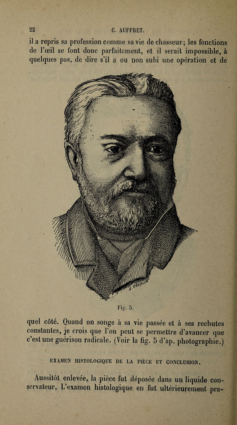 il a repris sa profession comme sa vie de chasseur; les fonctions de l’œil se font donc parfaitement, et il serait impossible, à quelques pas, de dire s’il a ou non subi une opération et de quel côté. Quand on songe à sa vie passée et à ses rechutes constantes, je crois que 1 on peut se permettre d’avancer que c est une guérison radicale. (Voir la fîg. 5 d’ap. photographie.) examen histologique de la pièce et conclusion. Aussitôt enlevée, la pièce fut déposée dans un liquide con¬ servateur. L examen histologique en fut ultérieurement pra-