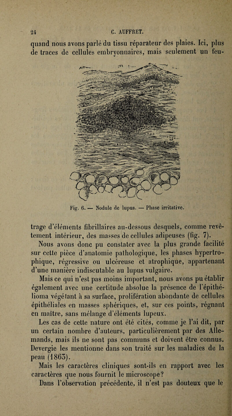 quand nous avons parlé du tissu réparateur des plaies. Ici, plus de traces de cellules embryonnaires, mais seulement un feu- Fig. 6. — Nodule de lupus. — Phase irritative. trage d’éléments fîbrillaires au-dessous desquels, comme revê¬ tement intérieur, des masses de cellules adipeuses (tig. 7). Nous avons donc pu constater avec la plus grande facilité sur cette pièce d’anatomie pathologique, les phases hypertro¬ phique, régressive ou ulcéreuse et atrophique, appartenant d’une manière indiscutable au lupus vulgaire. Mais ce qui n’est pas moins important, nous avons pu établir également avec une certitude absolue la présence de lépithé- lioma végélant à sa surface, prolifération abondante de cellules épithéliales en masses sphériques, et, sur ces points, régnant en maître, sans mélange d’éléments lupeux. Les cas de cette nature ont été cités, comme je l’ai dit, par un certain nombre d’auteurs, particulièrement par des Alle¬ mands, mais ils ne sont pas communs et doivent être connus. Devergie les mentionne dans son traité sur les maladies de la peau (1865). Mais les caractères cliniques sont-ils en rapport avec les caractères que nous fournit le microscope? Dans l’observation précédente, il n’est pas douteux que le