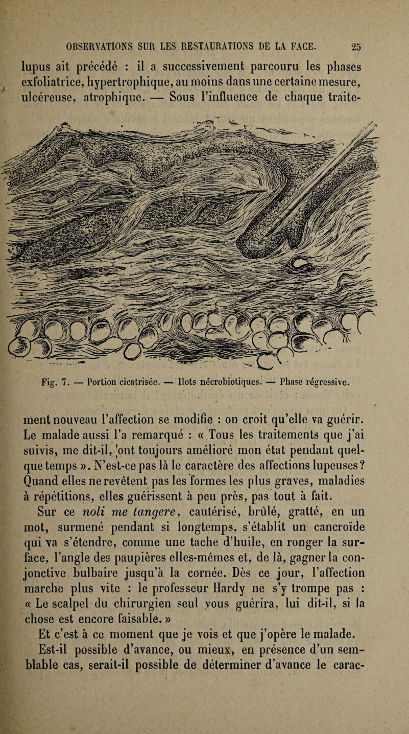 lupus ait précédé : il a successivement parcouru les phases exfoliatrice, hypertrophique, au moins dans une certaine mesure, ulcéreuse, atrophique. — Sous l’influence de chaque traite- Fig. 7. — Portion cicatrisée. — Ilots nécrobiotiques. — Phase régressive. ment nouveau l’affection se modifie : on croit qu’elle va guérir. Le malade aussi l’a remarqué : « Tous les traitements que j’ai suivis, me dit-il, 'ont toujours amélioré mon état pendant quel¬ que temps ». N’est-ce pas là le caractère des affections lupeuses? Quand elles ne revêtent pas les formes les plus graves, maladies à répétitions, elles guérissent à peu près, pas tout à fait. Sur ce noli me tangere, cautérisé, brûlé, gratté, en un mot, surmené pendant si longtemps, s’établit un cancroïde qui va s’étendre, comme une tache d’huile, en ronger la sur¬ face, l’angle des paupières elles-mêmes et, de là, gagner la con¬ jonctive bulbaire jusqu’à la cornée. Dès ce jour, l’affection marche plus vite : le professeur Hardy ne s’y trompe pas : « Le scalpel du chirurgien seul vous guérira, lui dit-il, si la chose est encore faisable. » Et c’est à ce moment que je vois et que j’opère le malade. Est-il possible d’avance, ou mieux, en présence d’un sem¬ blable cas, serait-il possible de déterminer d’avance le carac-