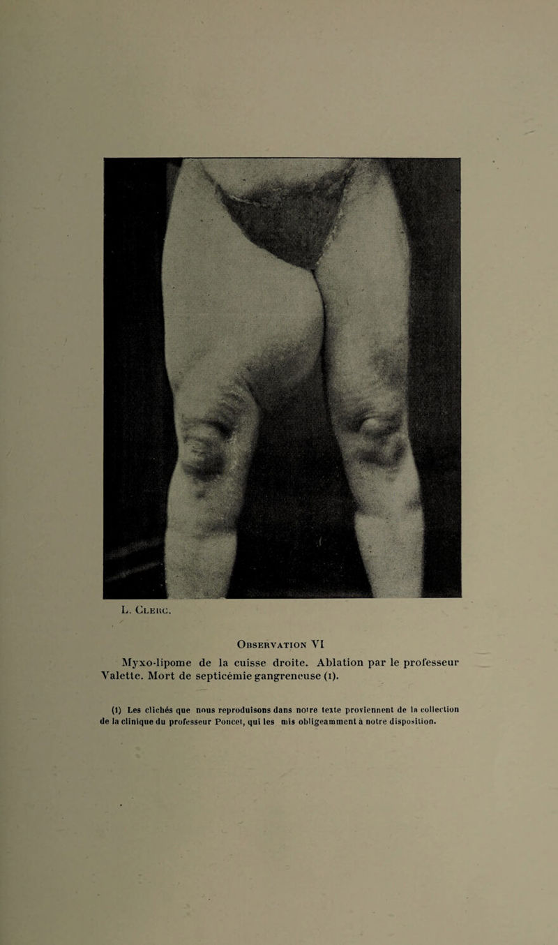 Observation YI Myxo-lipome de la cuisse droite. Ablation par le professeur Valette. Mort de septicémie gangreneuse (i). (1) Les clichés que nous reproduisons dans noire texte proviennent de la collection de la clinique du professeur Poucet, qui les mis obligeamment à notre disposition.