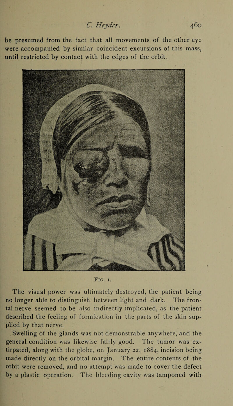 be presumed from the fact that all movements of the other eye were accompanied by similar coincident excursions of this mass, until restricted by contact with the edges of the orbit. Fig. 1. The visual power was ultimately destroyed, the patient being no longer able to distinguish between light and dark. The fron¬ tal nerve seemed to be also indirectly implicated, as the patient described the feeling of formication in the parts of the skin sup¬ plied by that nerve. . Swelling of the glands was not demonstrable anywhere, and the general condition was likewise fairly good. The tumor was ex¬ tirpated, along with the globe, on January 22, 1884, incision being made directly on the orbital margin. The entire contents of the orbit were removed, and no attempt was made to cover the defect by a plastic operation. The bleeding cavity was tamponed with