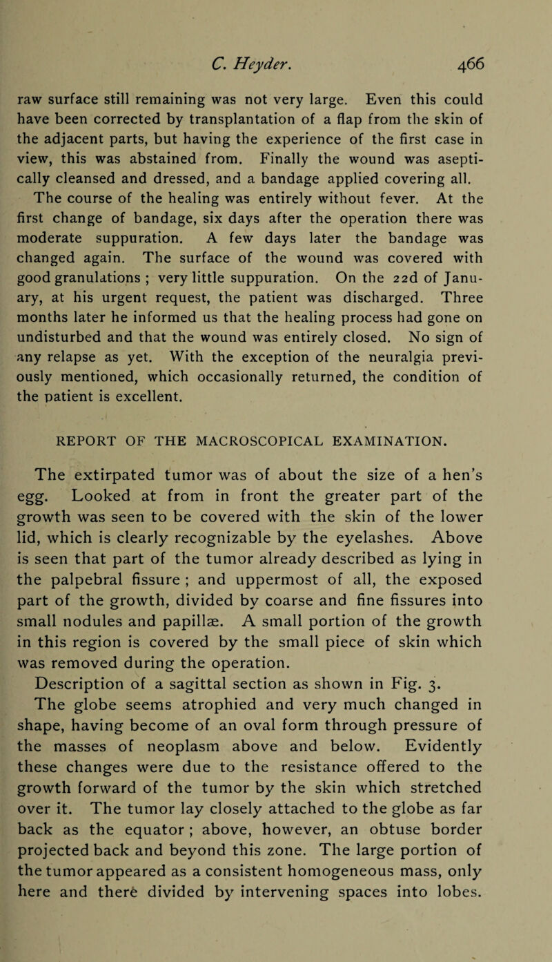 raw surface still remaining was not very large. Even this could have been corrected by transplantation of a flap from the skin of the adjacent parts, but having the experience of the first case in view, this was abstained from. Finally the wound was asepti- cally cleansed and dressed, and a bandage applied covering all. The course of the healing was entirely without fever. At the first change of bandage, six days after the operation there was moderate suppuration. A few days later the bandage was changed again. The surface of the wound was covered with good granulations ; very little suppuration. On the 22d of Janu¬ ary, at his urgent request, the patient was discharged. Three months later he informed us that the healing process had gone on undisturbed and that the wound was entirely closed. No sign of any relapse as yet. With the exception of the neuralgia previ¬ ously mentioned, which occasionally returned, the condition of the patient is excellent. REPORT OF THE MACROSCOPICAL EXAMINATION. The extirpated tumor was of about the size of a hen’s egg. Looked at from in front the greater part of the growth was seen to be covered with the skin of the lower lid, which is clearly recognizable by the eyelashes. Above is seen that part of the tumor already described as lying in the palpebral fissure ; and uppermost of all, the exposed part of the growth, divided by coarse and fine fissures into small nodules and papillae. A small portion of the growth in this region is covered by the small piece of skin which was removed during the operation. Description of a sagittal section as shown in Fig. 3. The globe seems atrophied and very much changed in shape, having become of an oval form through pressure of the masses of neoplasm above and below. Evidently these changes were due to the resistance offered to the growth forward of the tumor by the skin which stretched over it. The tumor lay closely attached to the globe as far back as the equator ; above, however, an obtuse border projected back and beyond this zone. The large portion of the tumor appeared as a consistent homogeneous mass, only here and there divided by intervening spaces into lobes.