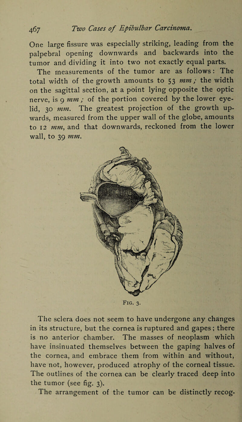 One large fissure was especially striking, leading from the palpebral opening downwards and backwards into the tumor and dividing it into two not exactly equal parts. The measurements of the tumor are as follows: The total width of the growth amounts to 53 mm; the width on the sagittal section, at a point lying opposite the optic nerve, is 9 mm ; of the portion covered by the lower eye¬ lid, 30 mm. The greatest projection of the growth up¬ wards, measured from the upper wall of the globe, amounts to 12 mm, and that downwards, reckoned from the lower wall, to 39 mm. Fig. 3. The sclera does not seem to have undergone any changes in its structure, but the cornea is ruptured and gapes; there is no anterior chamber. The masses of neoplasm which have insinuated themselves between the gaping halves of the cornea, and embrace them from within and without, have not, however, produced atrophy of the corneal tissue. The outlines of the cornea can be clearly traced deep into the tumor (see fig. 3). The arrangement of the tumor can be distinctly recog-