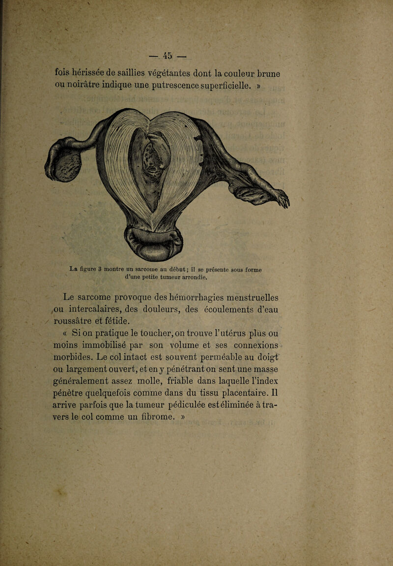 fois hérissée de saillies végétantes dont la couleur brune ou noirâtre indique une putrescence superficielle. » La figure B montre un sarcome au début ; il se présente sous forme d’une petite tumeur arrondie. Le sarcome provoque des hémorrhagies menstruelles ou intercalaires, des douleurs, des écoulements d’eau roussâtre et fétide. « Si on pratique le toucher,on trouve l’utérus plus ou moins immobilisé par son volume et ses connexions morbides. Le col intact est souvent perméable au doigt ou largement ouvert, et en y pénétrant on sent une masse généralement assez molle, friable dans laquelle l’index pénètre quelquefois comme dans du tissu placentaire. Il arrive parfois que la tumeur pédiculée est éliminée à tra¬ vers le col comme un fibrome. »